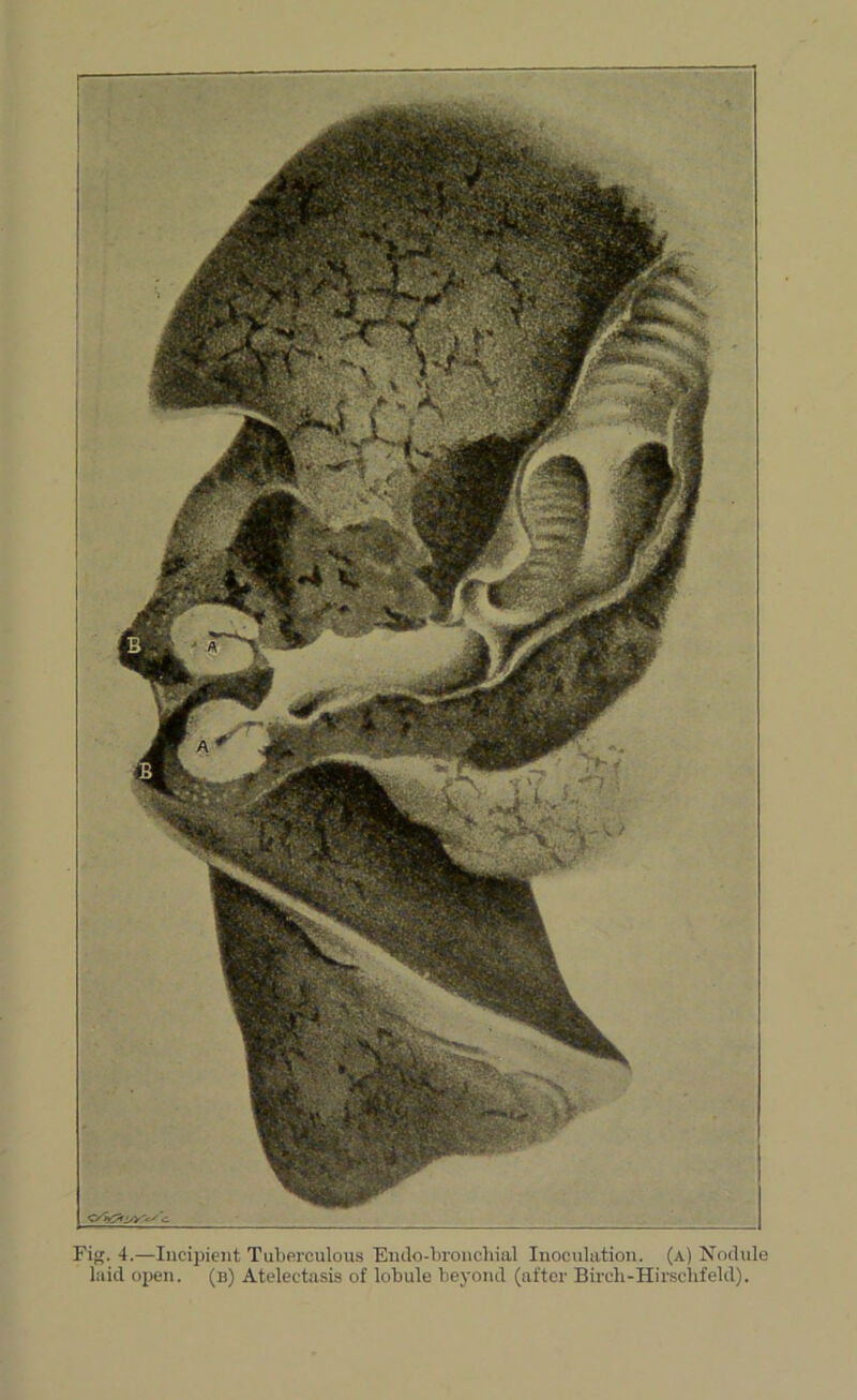 Fig. 4.—Incipient Tuberculous Enclo-broncliiiil Inoculation, (a) Nodule laid oiien. (b) Atelectasis of lobule beyond (after Birch-Hirsclifeld).