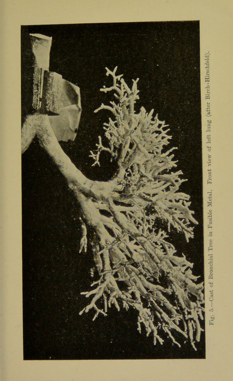 -Cast of Bi-oucliial Tree in Fusible Metal. Front view of left lung (after Bircb-Hirschfeld).