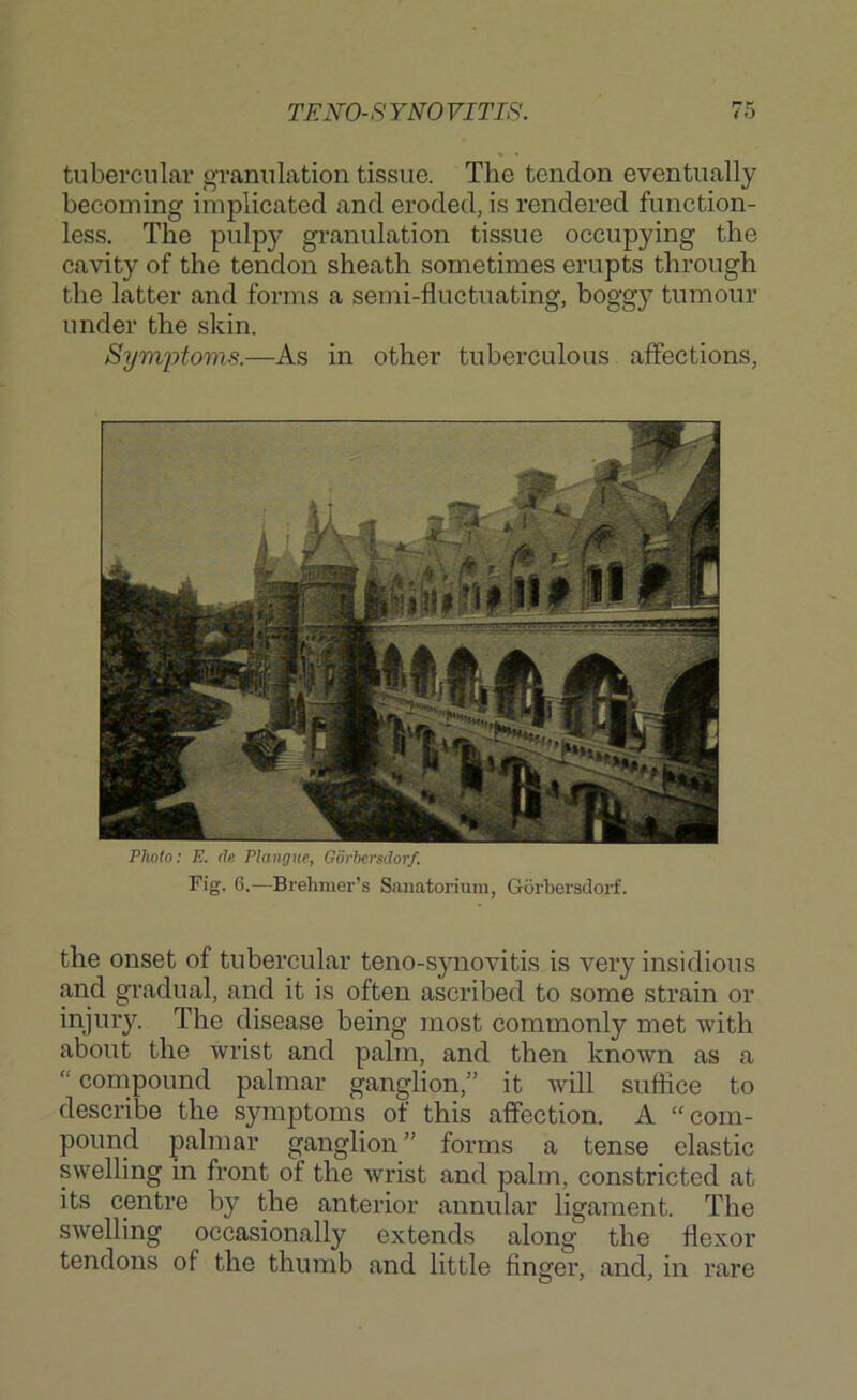 tubercular granulation tissue. The tendon eventually becoming implicated and eroded, is rendered function- less. The pulpy granulation tissue occupying the cavity of the tendon sheath sometimes erupts through the latter and forms a semi-fluctuating, boggy tumour under the skin. Sym27toms.—As in other tuberculous affections. Photo: E, fU Plangnef Gorbersdorf Fig. 6,—Brehmer’s Saiiatoriuin, Gorbersdorf. the onset of tubercular teno-synovitis is very insidious and gi’adual, and it is often ascribed to some strain or The disease being most commonly met with about the wrist and palm, and then known as a “ compound palmar ganglion,” it will sufiice to describe the symptoms of this affection. A “com- pound palmar ganglion” forms a tense elastic swelling in front of the wrist and palm, constricted at its centre by the anterior annular ligament. The swelling occasionally extends along the flexor tendons of the thumb and little finger, and, in rare