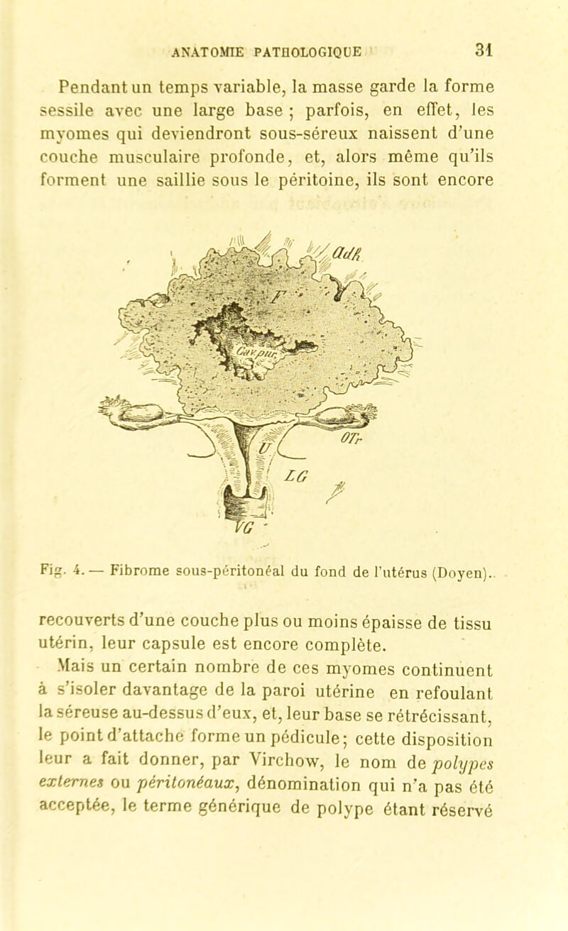 Pendant un temps variable, la masse garde la forme sessile avec une large base ; parfois, en effet, les myomes qui deviendront sous-séreux naissent d’une couche musculaire profonde, et, alors même qu’ils forment une saillie sous le péritoine, ils sont encore Fi. 4.— Fibrome sous-péritonéal du fond de l’utérus (Doyen). recouverts d’une couche plus ou moins épaisse de tissu utérin, leur capsule est encore complète. Mais un certain nombre de ces myomes continuent à s’isoler davantage de la paroi utérine en refoulant la séreuse au-dessus d’eux, et, leur base se rétrécissant, le point d’attache forme un pédicule; cette disposition leur a fait donner, par Virchow, le nom de polypes externes ou péritonéaux, dénomination qui n’a pas été acceptée, le terme générique de polype étant réservé