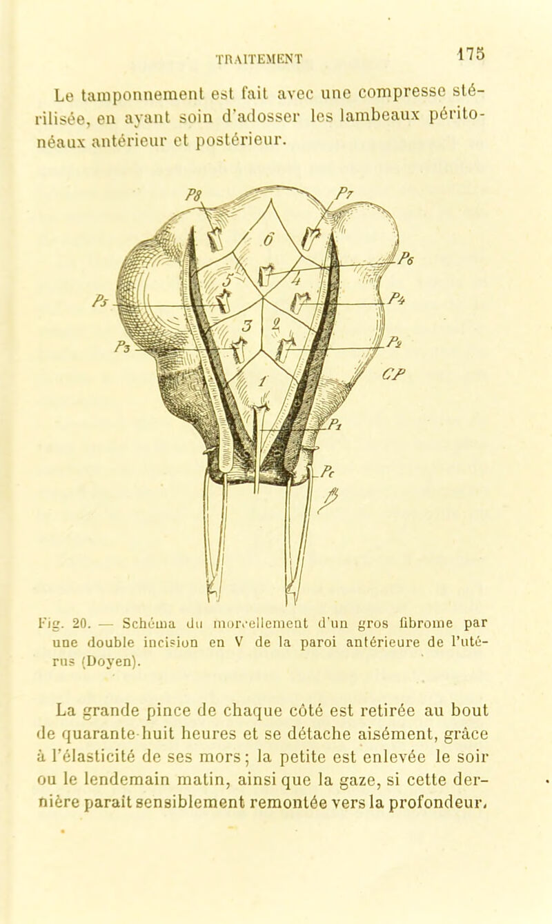 Le tamponnement est fait avec une compresse sté- rilisée, en ayant soin d’adosser les lambeaux périto- néaux antérieur et postérieur. Fig. 20. — Schéma du morcellement d’un gros fibrome par une double incision en V de la paroi antérieure de l’uté- rus (Doyen). La grande pince de chaque côté est retirée au bout de quarante huit heures et se détache aisément, grâce à l’élasticité de ses mors; la petite est enlevée le soir ou le lendemain matin, ainsi que la gaze, si cette der- nière parait sensiblement remontée vers la profondeur,