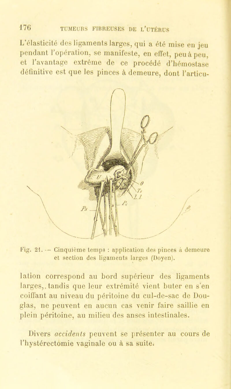 L’élasticité des ligaments larges, qui a été mise en jeu pendant l’opération, se manifeste, en effet, peu à peu, et l’avantage extrême de ce procédé d’hémostase définitive est que les pinces à demeure, dont l’articu- Fig. 2t. — Cinquième temps : application des pinces à demeure et section des ligaments larges (Doyen). 1 al ion correspond au bord supérieur des ligaments larges,.tandis que leur extrémité vient buter en s'en coiffant au niveau du péritoine du cul-de-sac de Dou- glas, ne peuvent en aucun cas venir faire saillie en plein péritoine, au milieu des anses intestinales. Divers accidents peuvent se présenter au cours de l’hystérectomie vaginale ou à sa suite.