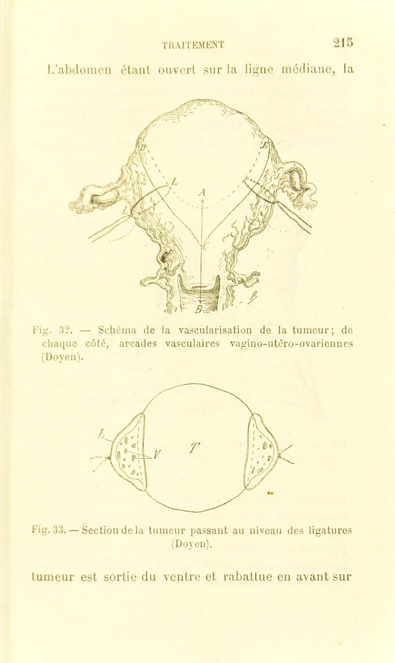 L’abdomen étant ouvert sur la ligne médiane, la Fig. 32. — Schéma de la vascularisation de la tumeur; de chaque côté, arcades vasculaires vagino-utcro-ovariennes (Doyen). Fig. 33. — Section de la tumeur passant au niveau des ligatures (Doyen). tumeur est sortie du ventre et rabattue en avant sur