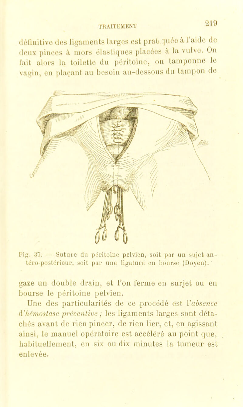 Fig. 37. — Suture du péritoine pelvien, soit par un sujet an- téro-postérieur, soit par une ligature eu bourse (Doyen). gaze un double drain, et l’on ferme en surjet ou en bourse le péritoine pelvien. Une des particularités de ce procédé est Vabsence d’hémostase préventive ; les ligaments larges sont déta- chés avant de rien pincer, de rien lier, et, en agissant ainsi, le manuel opératoire est accéléré au point que, habituellement, en six ou dix minutes la tumeur est enlevée. définitive des ligaments larges est prato piée à 1 aide de lieux pinces à mors élastiques placées a la vulve. Un l'ait alors la toilette du péritoine, ou tamponne le vagin, on plaçant au besoin au-dessous du tampon de