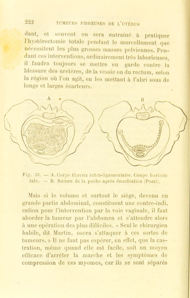 cla.nt, ut, souvent on sera entraîné à pratiquer 1 hystérectomie totale pendant le morcellement que nécessitent les plus grosses masses pelviennes. Pen- dant ces interventions, ordinairement très laborieuses, il faudra toujours se mettre en garde contre la blessure des uretères, de la vessie ou du rectum, selon la région où l’on agit, en les mettant à. l’abri sous de longs et larges écarteurs. Fig. 38. — A. Corps fibreux intra-ügaïuenlaire. Coupe horizon- tale. — B. Suture de la poche après énucléation (Pozzi). Mais si le volume et surtout le siège, devenu en grande partie abdominal, constituent une contre-indi- cation pour l’intervention par la voie vaginale, il faut aborder la tumeur par l’abdomen et s’attendre alors à une opération des plus difficiles. « Seul le chirurgien habile, dit Martin, osera s’attaquer à ces sortes de tumeurs. » Il ne faut pas espérer, en effet, que la cas- tration, même quand elle est facile, soit un moyen efficace d’arrêter la marche et les symptômes de compression de ces myomes, car ils se sont séparés