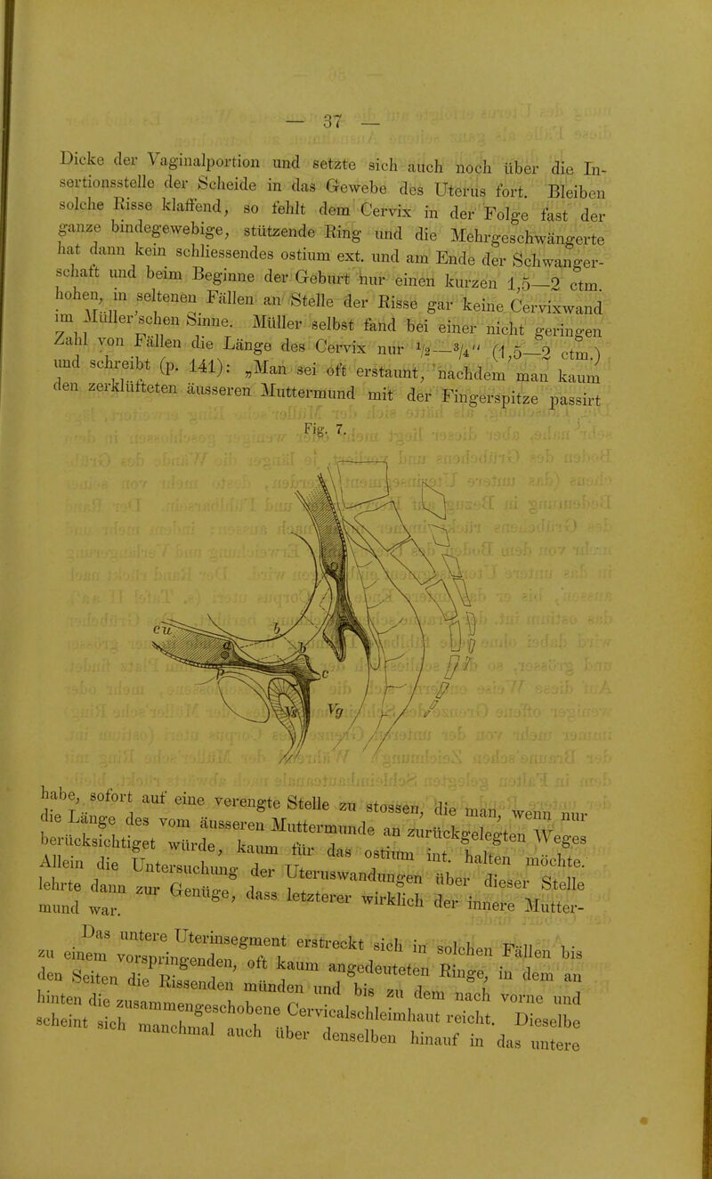 Dicke der Vaginalportion und setzte sieh auch noch über die In- sertionsstelle der Scheide in das Gewebe des Uterus fort Bleiben solche Risse klaffend, so fehlt dem Cervix in der Folge f'ast der ganze bindegewebige, stützende Ring und die Mehrgeschwängerte hat dann kern schliessendes ostium ext. und am Ende der Schwanger- schaft und beim Beginne der Geburt hur einen kurzen 1,5-2 ctm hohen m seltenen Fällen. an' .Stelle der Risse gar keine Cervixwand im Muller sehen binne. Müller selbst fand bei einer nicht geringen Zahl von Fällen die Länge des Cervix nur-^-3/i. ^ij, . und schreibt (p. 141): „Man^^er oft erstaunt, nachdem'man kaum den zerklüfteten äusseren Muttermund der Fingerspitze passirt Fig. 7. habe, sofort auf eine vereue-te Stpll<» -^t, ■ h« mund wai ' ' ^^^^^^ innere Mutter- Das untere TJterinsegment erstreckt sich in soloh^n i • zu einem vorsnn'nD-^.nrl^,. i soicHen allen bis manchmal auch über denselben hinauf in das untere