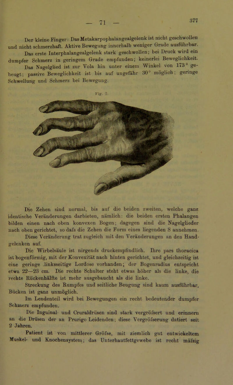 877 Der kleine Finger: Das Metakarpophalangealgelenk ist nicht geschwollen und nicht schmerzhaft. Aktive Bewegung innerhalb weniger Grade ausführbar. Das erste Interphalangealgelenk stark geschwollen; bei Druck wird ein dumpfer Schmerz in geringem Grade empfunden; keinerlei Beweglichkeit. Das Nagelglied ist zur Yola hin unter einem Winkel von 173° ge- beugt; passive Beweglichkeit ist bis auf ungefähr 30 möglich; geringe Schwellung und Schmerz bei Bewegung. l'ig. 2. Die Zehen sind normal, bis auf die beiden zweiten, welche ganz identische Veränderungen darbieten, nämlich: die beiden ersten Phalangen bilden einen nach oben konvexen Bogen; dagegen sind die Nagelglieder nach oben gerichtet, sodafs die Zehen die Form eines liegenden S annehmen. Diese Veränderung trat zugleich mit den Veränderungen an den Hand- gelenken auf. Die Wirbelsäule ist nirgends druckempfindlich. Ihre pars thoracica ist bogenförmig, mit der Konvexität nach hinten gerichtet, und gleichzeitig ist eine geringe .linksseitige Lordose vorhanden; der Bogenradius entspricht etwa 22—23 cm. Die rechte Schulter steht etwas höher als die linke, die rechte Rückenhälfte ist mehr ausgebaucht als die linke. Streckung des Rumpfes und seitliche Beugung sind kaum ausführbar, Bücken ist ganz unmöglich. Im Lendenteil wird bei Bewegungen ein recht bedeutender dumpfer Schmerz empfunden. Die Inguinal- und Cruraldrüsen sind stark vergröfsert und erinnern an die Drüsen der an Prurigo Leidenden; diese Vergröfserung datiert seit 2 Jahren. Patient ist von mittlerer Gröfse, mit ziemlich gut entwickeltem Muskel- und Knochensystem; das Unterhautfettgewebe ist recht mäfsig