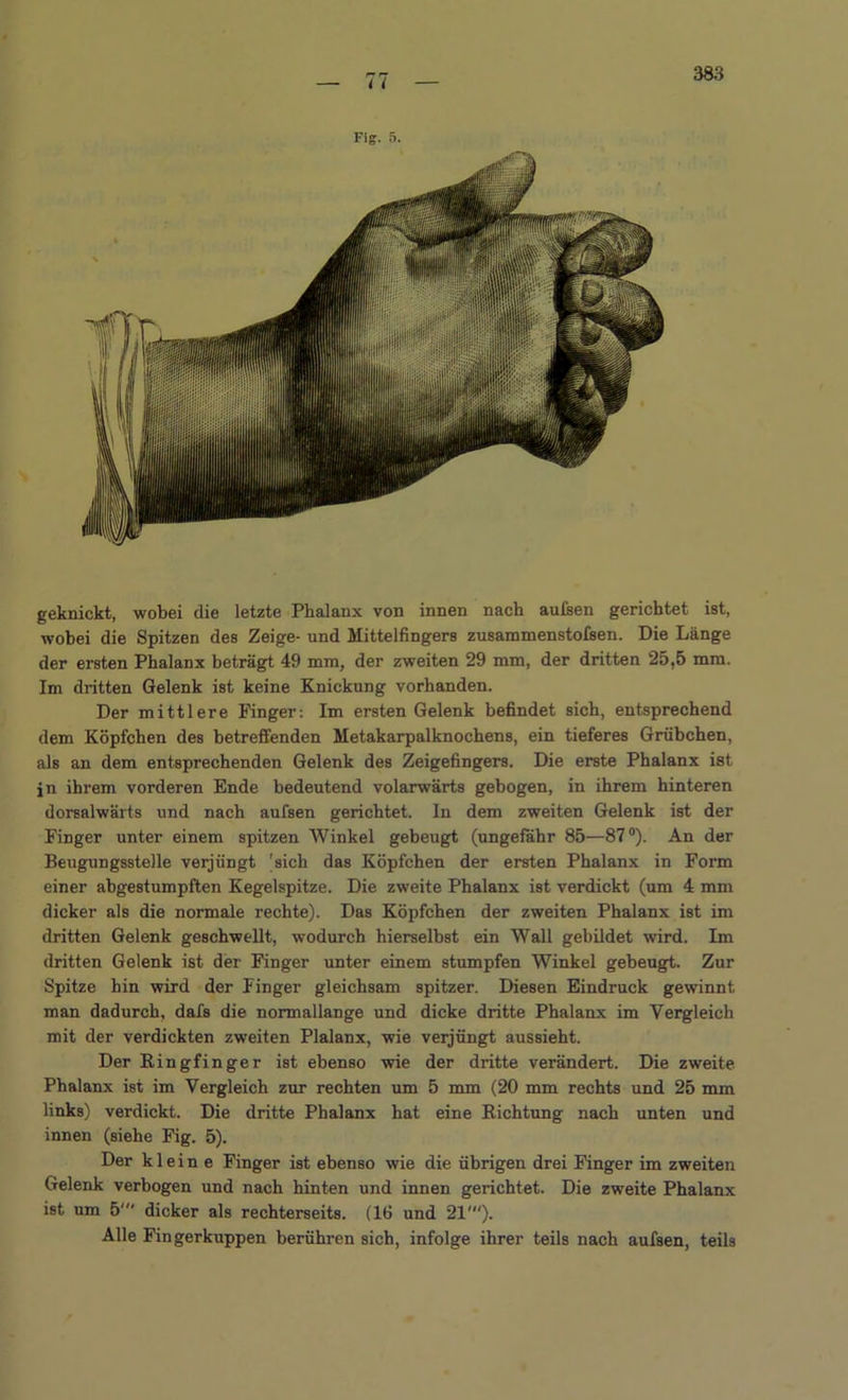 383 geknickt, wobei die letzte Phalanx von innen nach aufsen gerichtet ist, wobei die Spitzen des Zeige- und Mittelfingers zusammenstofsen. Die Länge der ersten Phalanx beträgt 49 mm, der zweiten 29 mm, der dritten 25,5 mm. Im dritten Gelenk ist keine Knickung vorhanden. Der mittlere Finger: Im ersten Gelenk befindet sich, entsprechend dem Köpfchen des betreffenden Metakarpalknochens, ein tieferes Grübchen, als an dem entsprechenden Gelenk des Zeigefingers. Die erste Phalanx ist in ihrem vorderen Ende bedeutend volarwärts gebogen, in ihrem hinteren dorsalwärts und nach aufsen gerichtet. In dem zweiten Gelenk ist der Finger unter einem spitzen Winkel gebeugt (ungefähr 85—87°). An der Beugungsstelle verjüngt 'sich das Köpfchen der ersten Phalanx in Form einer abgestumpften Kegelspitze. Die zweite Phalanx ist verdickt (um 4 mm dicker als die normale rechte). Das Köpfchen der zweiten Phalanx ist im dritten Gelenk geschwellt, -wodurch hierselbst ein Wall gebildet wird. Im dritten Gelenk ist der Finger unter einem stumpfen Winkel gebeugt. Zur Spitze hin wird der Finger gleichsam spitzer. Diesen Eindruck gewinnt man dadurch, dafs die normallange und dicke dritte Phalanx im Vergleich mit der verdickten zweiten Plalanx, wie verjüngt aussieht. Der Ringfinger ist ebenso wie der dritte verändert. Die zweite Phalanx ist im Vergleich zur rechten um 5 mm (20 mm rechts und 25 mm links) verdickt. Die dritte Phalanx hat eine Richtung nach unten und innen (siehe Fig. 5). Der klein e Finger ist ebenso wie die übrigen drei Finger im zweiten Gelenk verbogen und nach hinten und innen gerichtet. Die zweite Phalanx ist um 5' dicker als rechterseits. (16 und 21'). Alle Fingerkuppen berühren sich, infolge ihrer teils nach aufsen, teils