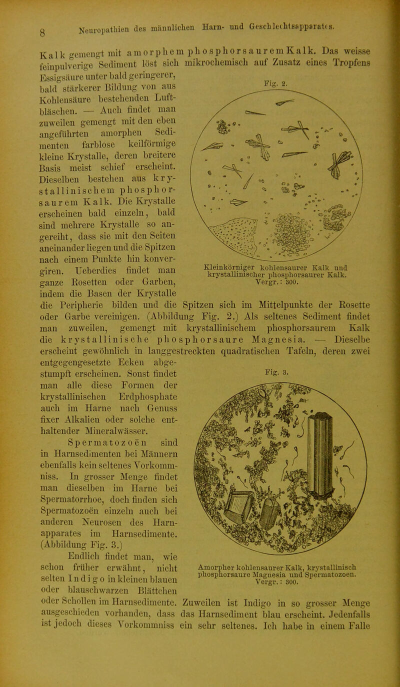 Kalk -emeng-t mit a m o r p Ii e m p h o s p h o r s a u r e m K a 1 k. Das weisse feinpulverige Sediment löst sich mikrochemisch auf Zusatz emes Tropfens Essigsäure unter bald geringerer, bald stärkerer Bildung von aus Kohlensäure bestehenden Luft- bläschen. — Auch findet man zuweilen gemengt mit den eben angeführten amorplien Sedi- menten farblose keilförmige kleine Krystalle, deren breitere Basis meist schief erscheint. Dieselben bestehen aus kry- stallinischem phosphor- saurem Kalk. Die Krystalle erscheinen bald einzeln, bald sind mehrere Krystalle so an- gereiht , dass sie mit den Seiten aneinander liegen und die Spitzen nach einem Punkte hin konver- giren. Ueberdies findet man ganze Rosetten oder Garben, indem die Basen der Krystalle die Peripherie bilden und die Spitzen sich im Mittelpunkte der Rosette oder Garbe vereinigen. (Abbildung Fig. 2.) Als seltenes Sediment findet man zuweilen, gemengt mit laystallinischem phosphorsaurem Kalk die krystallinische phosphorsaure Magnesia. — Dieselbe erscheint gewöhnlich in langgestreckten quadratischen Tafeln, deren zwei entgegengesetzte Ecken abge- Kleinkörniger kohlensaurer Kalk und krystallinischer pliosphorsaurer Kalk. Vergr.: aoo. stumpft erscheinen. Sonst findet man alle diese Formen der krystallinischen Erdphosphate auch im Harne nach Genuss fixer Alkalien oder solche ent- haltender Mineralwässer. Spermatozoen sind in Harnsedimenten bei Männern ebenfalls kein seltenes Vorkomm- niss. Li grosser Menge findet man dieselben im Harne bei Spermatorrhoe, doch finden sich Spermatozoen einzeln auch bei anderen Neurosen des Harn- apparates im Harnsedimente. (Abbildung Fig. 3.) Endlich findet man, wie schon früher erwähnt, nicht selten I n d i g o in kleinen blauen oder blauschwarzen Blättchen oder Schollen im Harnsedimente, ausgeschieden vorhanden, dass ist jedoch dieses Vorkommuiss Fig. 3. Amorpher kohlensaurer Kalk, krystallinisch phospuorsaure Magnesia und Spermatozoen. Vergr.: 300. Indigo Zuweilen ist das Harnsediment ein sehr seltenes. Menge m so grosser blau erscheint. Jedenfalls Ich habe in einem Falle