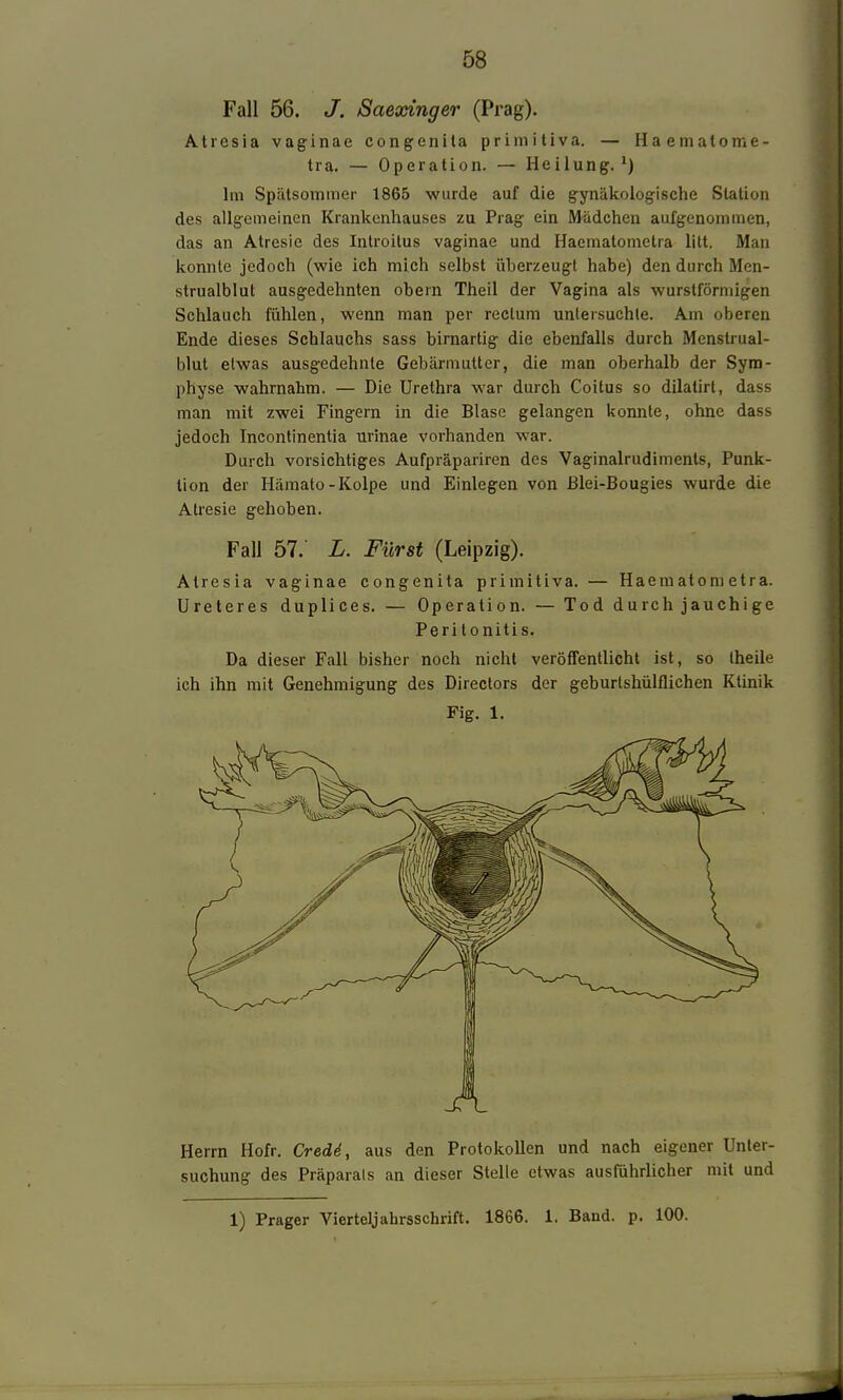 Fall 56. J. Saexinger (Prag). Atresia vaginae congenita priniitiva. — Haemalome- tra. — Operation. — Heilung.') Im Spätsommer 1865 wurde auf die gynäkologische Station des allgemeinen Krankenhauses zu Prag ein Mädchen aufgenommen, das an Atresie des Introitus vaginae und Haematomctra litt. Man konnte jedoch (wie ich mich selbst überzeugt habe) den durch Men- strualblut ausgedehnten obern Theil der Vagina als wurstförmigen Schlauch fühlen, wenn man per rectum untersuchte. Am oberen Ende dieses Schlauchs sass birnartig die ebenfalls durch Menstrual- blut etwas ausgedehnte Gebärmutter, die man oberhalb der Sym- physe wahrnahm. — Die Urethra war durch Coitus so dilatirt, dass man mit zwei Fingern in die Blase gelangen konnte, ohne dass jedoch Incontinentia urinae vorhanden war. Durch vorsichtiges Aufpräpariren des Vaginalrudiments, Punk- tion der Hämato-Kolpe und Einlegen von ßlei-Bougies wurde die Atresie gehoben. Fall 57.' L. Fürst (Leipzig). Atresia vaginae congenita primitiva. — Haematoni etra. Ureteres duplices. — Operation. — Tod durch jauchige Peritonitis. Da dieser Fall bisher noch nicht veröffentlicht ist, so (heile ich ihn mit Genehmigung des Directors der geburtshülflichen Ktinik Fig. 1. Herrn Hofr. Credd, aus den Protokollen und nach eigener Unter- suchung des Präparats an dieser Stelle etwas ausführlicher mit und 1) Prager Vierteljahrsschrift. 1866. 1. Band. p. 100.