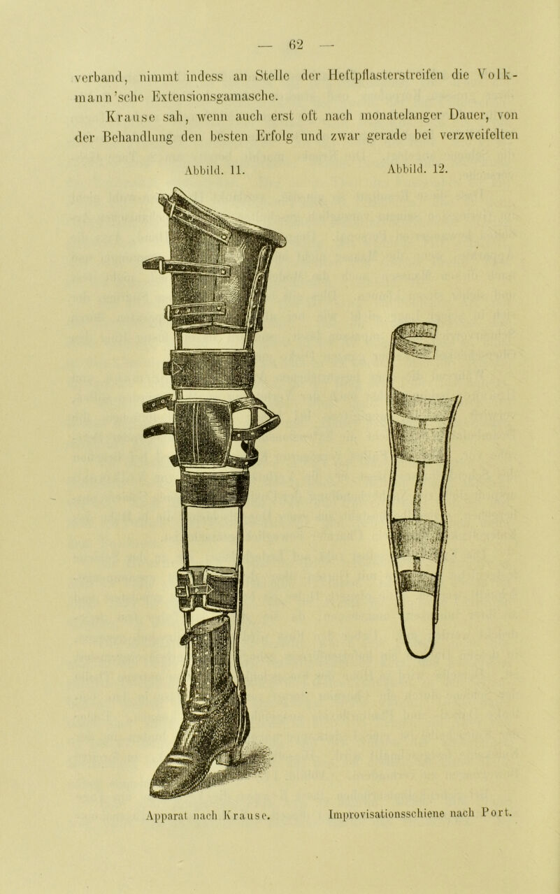 verband, nimmt inclcsü an Stelle der Hel’tpllasterstreifen die Volle- rn an n ’sche t^xtensionsgamasche. Krause sah, wenn auch erst oft nach monatelanger Dauer, von der Behandlung den besten Erfolg und zwar gei-ade bei verzweifelten Abbild. 11. Abbild. 12. Apparat nach K raus o. linprovisationsschiene nach Port.