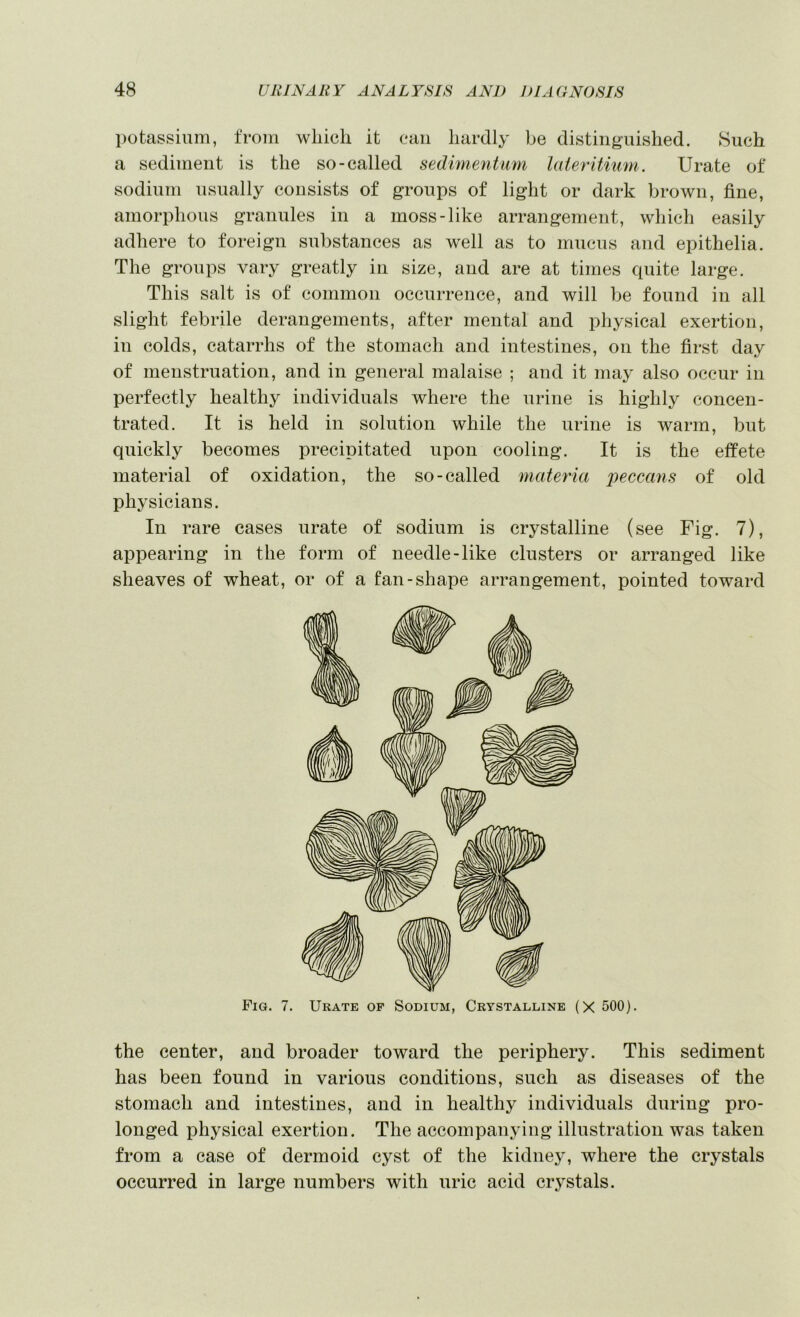 potassium, from which it can hardly be distinguished. Such a sediment is the so-called sedimentum lateritium. Urate of sodium usually consists of groups of light or dark brown, fine, amorphous granules in a moss-like arrangement, which easily adhere to foreign substances as well as to mucus and epithelia. The groups vary greatly in size, and are at times quite large. This salt is of common occurrence, and will be found in all slight febrile derangements, after mental and physical exertion, in colds, catarrhs of the stomach and intestines, on the first day of menstruation, and in general malaise ; and it may also occur in perfectly healthy individuals where the urine is highly concen- trated. It is held in solution while the urine is warm, but quickly becomes precipitated upon cooling. It is the effete material of oxidation, the so-called materia i)eceans of old physicians. In rare cases urate of sodium is crystalline (see Fig. 7), appearing in the form of needle-like clusters or arranged like sheaves of wheat, or of a fan-shape arrangement, pointed toward Fig. 7. Urate op Sodium, Crystalline (X 500). the center, and broader toward the periphery. This sediment has been found in various conditions, such as diseases of the stomach and intestines, and in healthy individuals during pro- longed physical exertion. The accompanying illustration was taken from a case of dermoid cyst of the kidnejq where the crystals occurred in large numbers with uric acid crj'Stals.