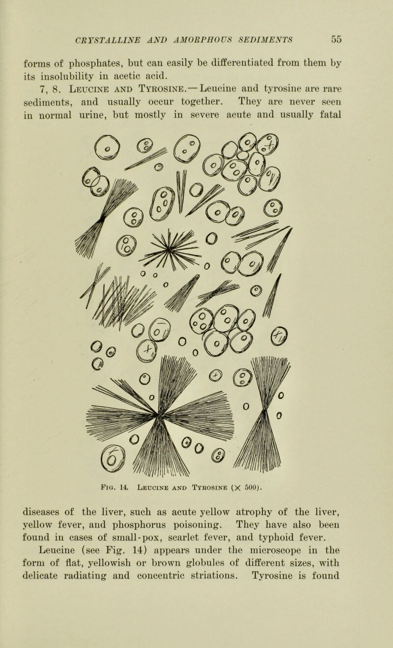 forms of phosphates, but can easily be differentiated from them by its insolubility in acetic acid. 7, 8. Leucine and Tyrosine.— Leucine and tyrosine are rare sediments, and usually occur together. They are never seen in normal urine, but mostly in severe acute and usually fatal Fig. 14. Leucine and Tyrosine (X 500). diseases of the liver, such as acute yellow atrophy of the liver, yellow fever, and phosphorus poisoning. They have also been found in cases of small-pox, scarlet fever, and typhoid fever. Leucine (see Fig. 14) appears under the microscope in the form of fiat, yellowish or brown globules of different sizes, with delicate radiating and concentric striations. Tyrosine is found