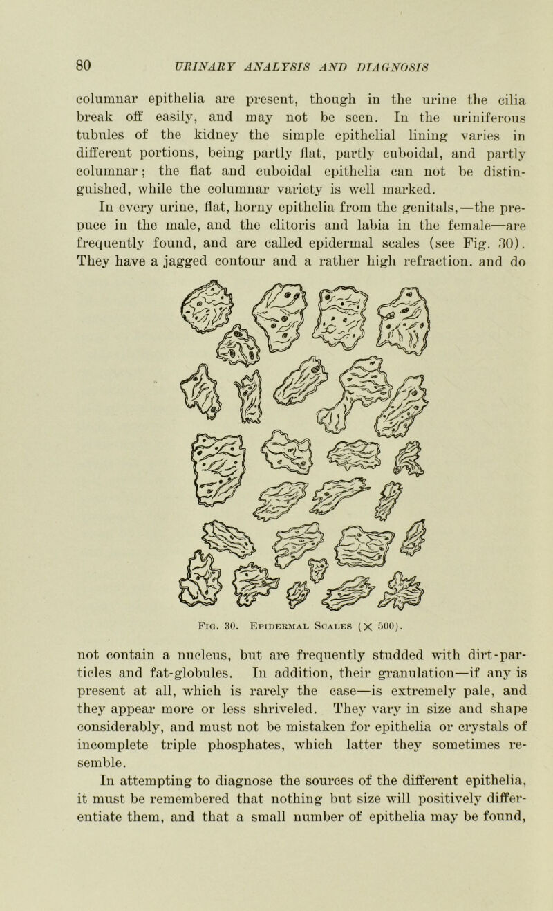 columnar epithelia are present, though in the urine the cilia break off easily, and may not be seen. In the uriniferous tubules of the kidney the simple epithelial lining varies in different portions, being partly flat, partly cuboidal, and partly columnar; the flat and cuboidal epithelia can not be distin- guished, while the columnar vaidety is well marked. In every urine, flat, horny epithelia from the genitals,—the pre- puce in the male, and the clitoris and labia in the female—are frequently found, and are called epidermal scales (see Fig. 30). They have a jagged contour and a rather high refraction, and do not contain a nucleus, but are frequently studded with dirt-par- ticles and fat-globules. In addition, their granulation—if anj^ is present at all, whieh is rarely the case—is extremely pale, and they appear more or less shriveled. They vary in size and shape considerably, and must not be mistaken for epithelia or crystals of incomplete triple phosphates, which latter they sometimes re- semble. In attempting to diagnose the sources of the different epithelia, it must be remembered that nothing but size will positively differ- entiate them, and that a small number of epithelia may be found.