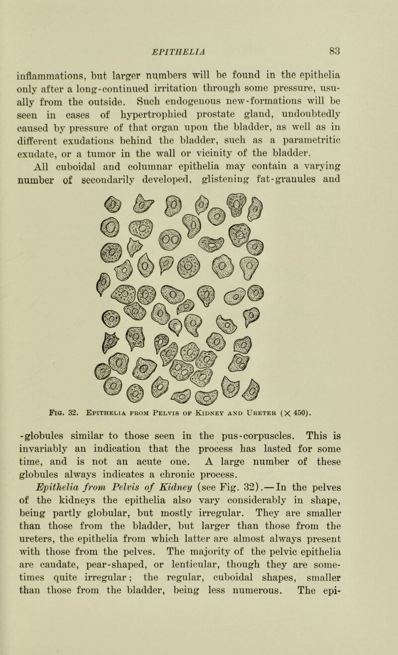 inflammations, but larger numbers will be found in the epithelia only after a long-continued irritation through some pressure, usu- ally from the outside. Such endogenous new-formations will be seen in cases of hypertrophied prostate gland, undoubtedly caused hy pressure of that organ upon the bladder, as well as in different exudations behind the bladder, such as a parametritic exudate, or a tumor in the wall or vicinity of the bladder. All cuboidal and columnar epithelia may contain a varying number of secondarily developed, glistening fat-granules and Fig. 32. Epithelia prom Pelvis op Kidney and Ureter (X 450). -globules similar to those seen in the pus-corpuscles. This is invariably an indication that the process has lasted for some time, and is not an acute one. A large number of these globules always indicates a chronic process. Epithelia from Pelvis of Kidney (see Fig. 32). — In the pelves of the kidneys the eijithelia also vary considerably in shape, being partly globular, but mostly irregular. They are smaller than those from the bladder, but larger than those from the ureters, the epithelia from which latter are almost always present with those from the pelves. The majority of the pelvic epithelia are caudate, pear-shaped, or lenticular, though they are some- times quite irregular; the regular, cuboidal shapes, smaller than those from the bladder, being less numerous. The epi-