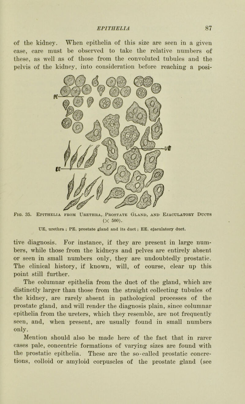 of the kidney. When epithelia of this size are seen in a given case, care inust be observed to take the relative numbers of these, as well as of those from the convoluted tubules and the pelvis of the kidney, into consideration before reaching a posi- Fig. 35. Epithelia from Urethra, Prostate Gland, and Ejaculatory Ducts (X 500). UE, urethra ; PE, prostate gland and its duct; EE, ejaculatory duct. tive diagnosis. For instance, if they are present in large num- bers, while those from the kidneys and pelves are entirely absent or seen in small numbers only, they are undoubtedly prostatic. The clinical history, if known, will, of course, clear up this point still further. The columnar epithelia from the duct of the gland, which are distinctly larger than those from the straight collecting tubules of the kidney, are rarely absent in pathological processes of the prostate gland, and will render the diagnosis plain, since columnar epithelia from the ureters, which they resemble, are not frequently seen, and, when present, are usually found in small numbers only. Mention should also be made here of the fact that in rarer cases pale, concentric formations of varying sizes are found with the prostatic epithelia. These are the so-called prostatic concre- tions, colloid or amyloid corpuscles of the prostate gland (see