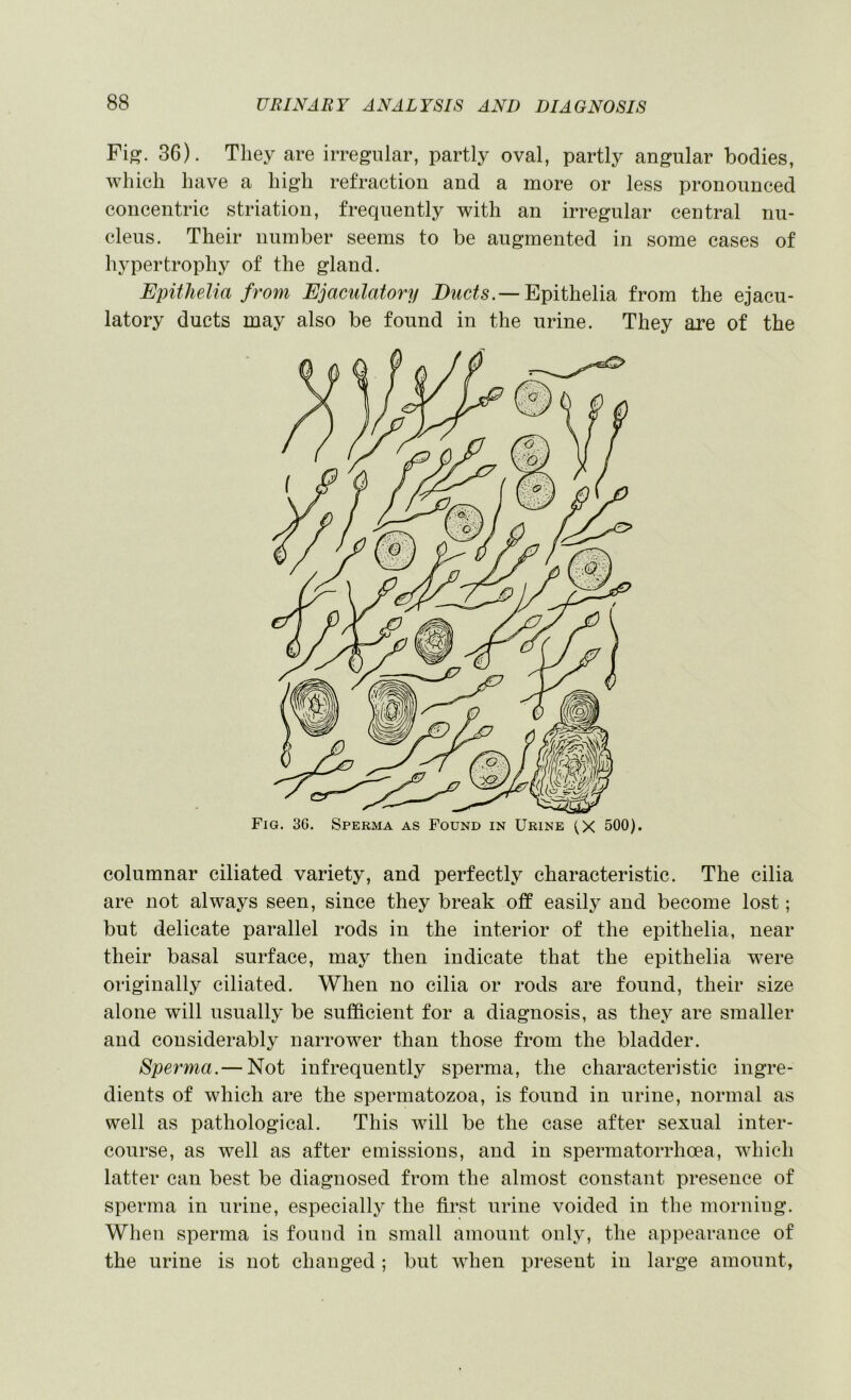 Fig. 36). They are irregular, partly oval, partly angular bodies, which have a high refraction and a more or less pronounced concentric striation, frequently with an irregular central nu- cleus. Their number seems to be augmented in some cases of hypertroph}^ of the gland. Epiilielia from Ejaculatory Epithelia from the ejacu- latory ducts may also be found in the urine. They are of the Fig. 36. Sperma as Found in Urine (X 500). columnar ciliated variety, and perfectly characteristic. The cilia are not always seen, since they break off easilj^ and become lost; but delicate parallel rods in the interior of the epithelia, near their basal surface, may then indicate that the epithelia were originally ciliated. When no cilia or rods are found, their size alone will usually be sufficient for a diagnosis, as they are smaller and considerably narrower than those from the bladder. Sperma.— Not infrequently sperma, the characteristic ingre- dients of which are the spermatozoa, is found in urine, normal as well as pathological. This will be the case after sexual inter- course, as well as after emissions, and in spermatorrhoea, which latter can best be diagnosed from the almost constant presence of sperma in urine, especially the first urine voided in the morning. When sperma is found in small amount only, the appearance of the urine is not changed ; but when present in large amount,