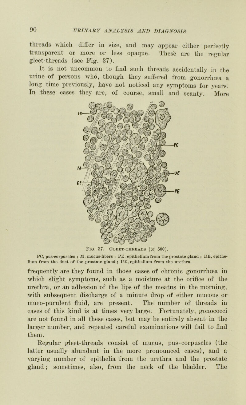 threads which differ in size, and may appear either perfectly transparent or more or less opaque. These are the regular gleet-threads (see Fig. 37). It is not uncommon to find such threads accidentally in the urine of persons who, though they suffered from gonorrhoea a long time previously, have not noticed any symptoms for years. In these cases they are, of course, small and scanty. More Fig. 37. Gleet-threads (X 500). PC, pus-eorpuscles ; M, mucus-fibers ; PE, epithelium from the prostate gland ; DE, epithe- lium from the duct of the prostate gland ; UE, epithelium from the urethra. frequently are they found in those cases of chronic gonorrhoea in which slight symptoms, such as a moisture at the orifice of the urethra, or an adhesion of the lips of the meatus in the morning, with subsequent discharge of a minute drop of either mucous or muco-purulent fluid, are present. The number of threads in cases of this kind is at times very large. Fortunately, gonococci are not found in all these cases, but may be entirely absent in the larger number, and repeated careful examinations will fail to find them. Regular gleet-threads consist of mucus, pus-corpuscles (the latter usually abundant in the more pronounced cases), and a varying number of epithelia from the urethra and the prostate gland; sometimes, also, from the neck of the bladder. The