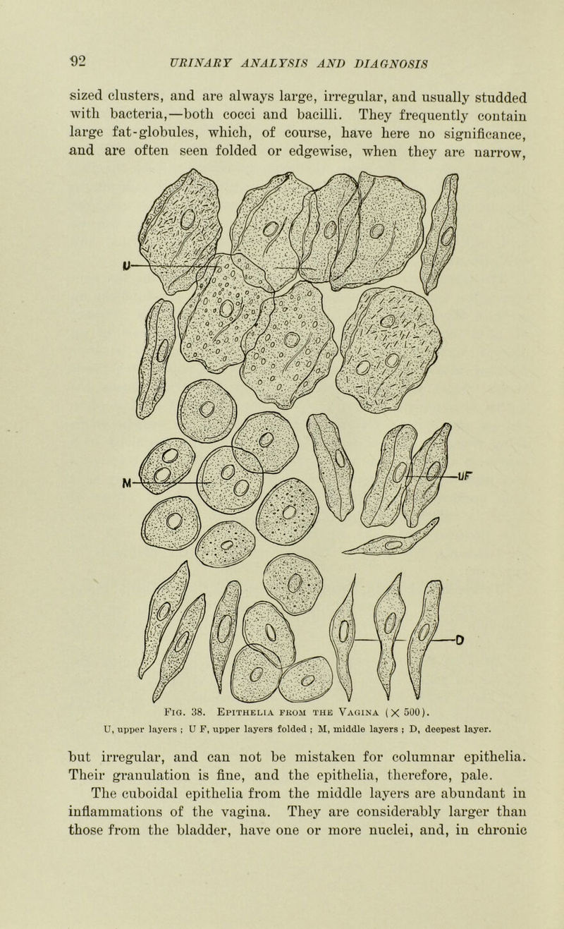 <)2 sized clusters, aud are always large, irregular, and usually studded with bacteria,—both cocci and bacilli. They frequently contain large fat-globules, which, of course, have here no significance, and are often seen folded or edgewise, when they are narrow, Fig. 38. Epitheha fkom the Vagina (X 500). U, upper layers ; U F, upper layers folded ; M, middle layers ; D, deepest layer. but irregular, and can not be mistaken for columnar epithelia. Their granulation is fine, and the epithelia, therefore, pale. The cuboidal epithelia from the middle layers are abundant in inflammations of the vagina. They are considerably larger than those from the bladder, have one or more nuclei, and, in chronic