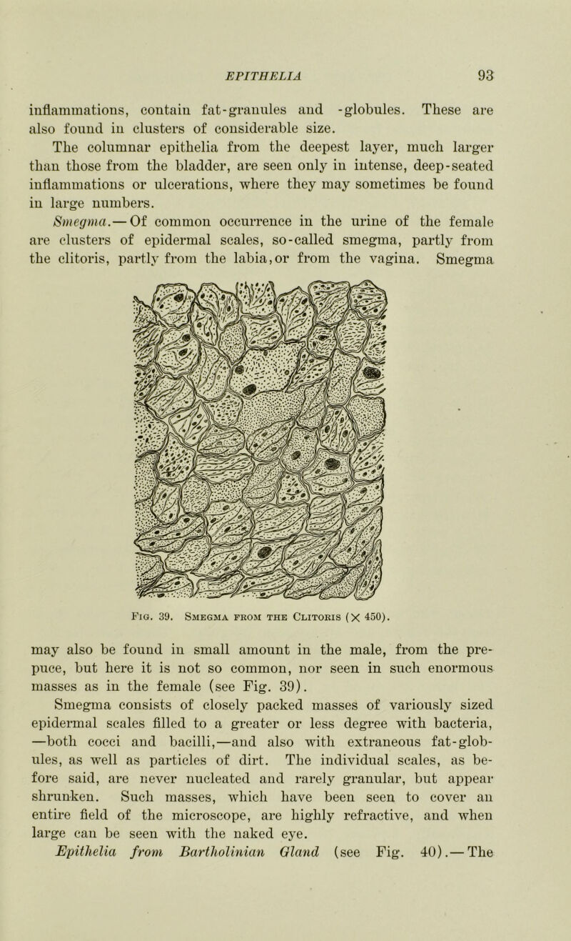 inflammations, contain fat-grannies and -globules. These are also found in clusters of considerable size. The columnar epithelia from the deepest layer, much larger than those from the bladder, are seen only in intense, deep-seated inflammations or ulcerations, where they may sometimes be found in large numbers. Smegma.— Of common occurrence in the urine of the female are clusters of epidermal scales, so-called smegma, partly from the clitoris, partly from the labia,or from the vagina. Smegma Fig. 39. Smegma prom the Clitoris (X 450). may also be found in small amount in the male, from the pre- puce, but here it is not so common, nor seen in such enormous masses as in the female (see Fig. 39). Smegma consists of closely packed masses of variously sized epidermal scales filled to a greater or less degree with bacteria, —both cocci and bacilli,—and also with extraneous fat-glob- ules, as well as particles of dirt. The individual scales, as be- fore said, are never nucleated and rarely granular, but appear shrunken. Such masses, which have been seen to cover an entire field of the microscope, are highly refractive, and when large can be seen with the naked eye. Epithelia from BartJiolmian Gland (see Fig. 40).— The