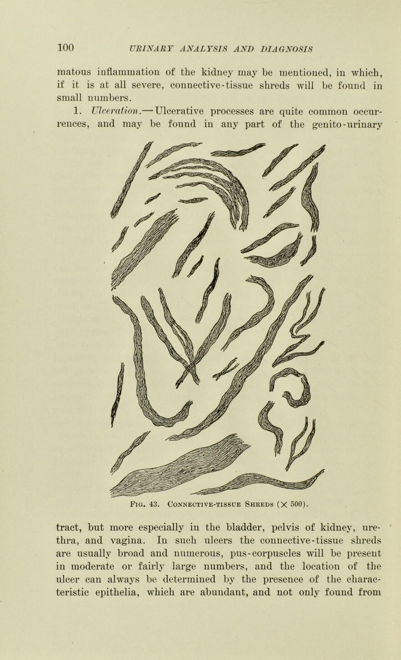 matous inflammation of the kidney may be mentioned, in which, if it is at all severe, connective-tissue shreds will be found in small numbers. 1. Ulceration.— Ulcerative processes are quite common occur- rences, and may be found in any part of the genito-urinary Fig. 43. Connective-tissue Shreds (X 500). tract, but more especially in the bladder, pelvis of kidney, ure- thra, and vagina. In such ulcers the connective-tissue shreds are usually broad and numerous, pus-corpuscles will be present in moderate or fairly large numbers, and the location of the ulcer can always be determined hy the presence of the charac- teristic epithelia, which are abundant, and not only found from