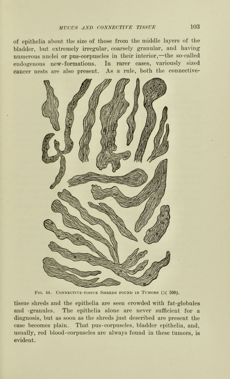 of epithelia about the size of those from the middle layers of the bladder, but extremely irregular, coarsely granular, and having numerous nuclei or pus-corpuscles in their interior,—the so-called endogenous new-formations. In rarer cases, variously sized cancer nests are also present. As a rule, both the connective- FiG. 44. Connective-tissue Shreds found in Tumors (X 500). tissue shreds and the epithelia are seen crowded with fat-globules and -granules. The epithelia alone are never sufficient for a diagnosis, but as soon as the shreds just described are present the case becomes plain. That pus-corpuscles, bladder epithelia, and, usually, red blood-corpuscles are always found in these tumors, is evident.