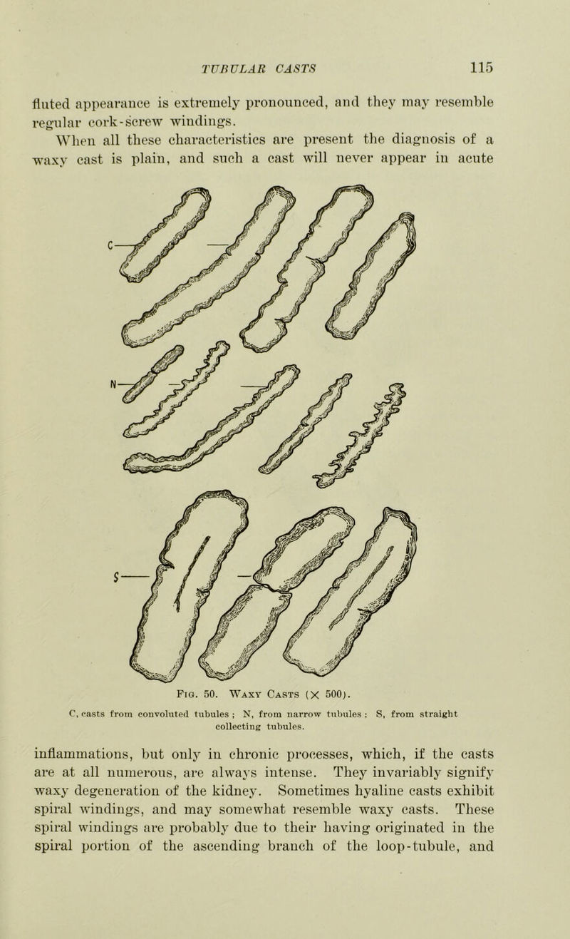 fluted appearance is extremely pronounced, and they may resemble regular cork-screw windings. When all these characteristics are present the diagnosis of a waxy cast is plain, and such a cast will never appear in acute Fig. 50. Waxy Casts (X 500). C, casts from convoluted tubules ; N, from narrow tubules ; S, from straight collecting tubules. inflammations, but only in chronic processes, which, if the casts are at all numerous, are always intense. They invariably signify waxy degeneration of the kidney. Sometimes hyaline casts exhibit spiral windings, and may somewhat resemble waxy casts. These spiral windings are probably due to their having originated in the spiral portion of the ascending branch of the loop-tubule, and