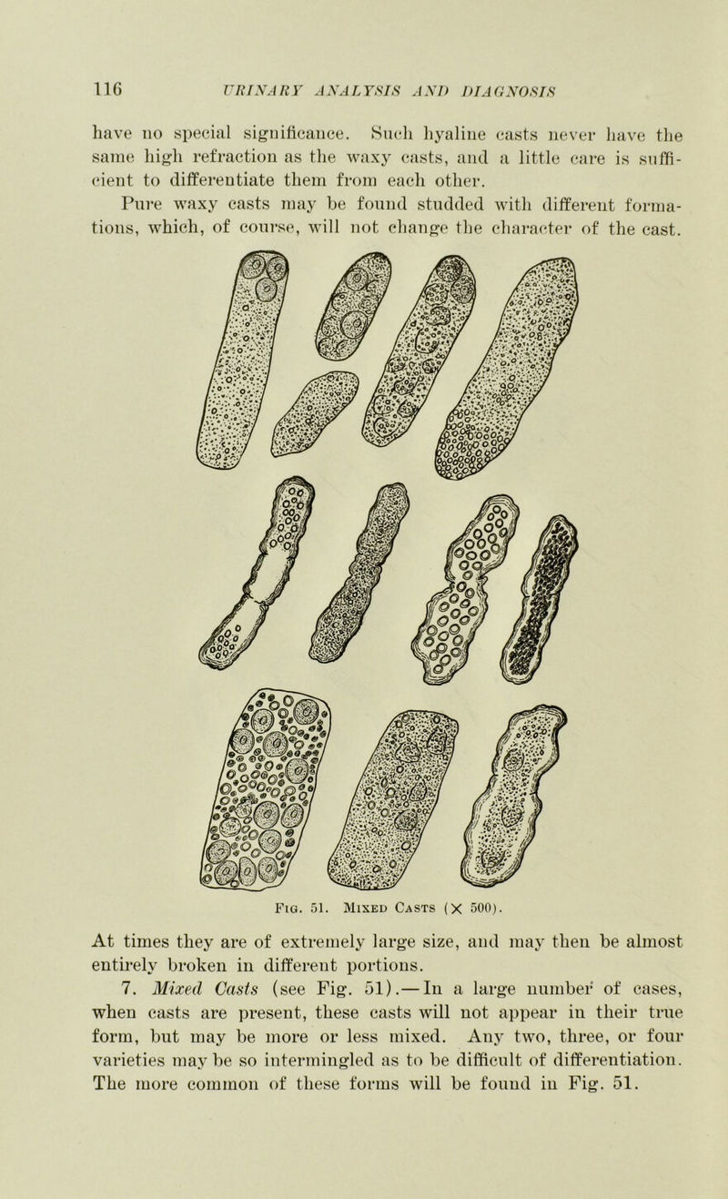 have 110 special significance. Such hyaline casts never have the same high refraction as the waxy casts, and a little care is suffi- cient to differentiate them from each other. Pure waxy casts may be found studded with different forma- tions, which, of course, will not change the character of the cast. At times they are of extremely large size, and may then be almost entirely broken in different portions. 7. Mixed Casts (see Fig. 51).— In a large number of cases, when casts are present, these casts will not appear in their true form, but may be more or less mixed. Any two, three, or four varieties maybe so intermingled as to be difficult of differentiation. The more common of these forms will be found in Fig. 51.