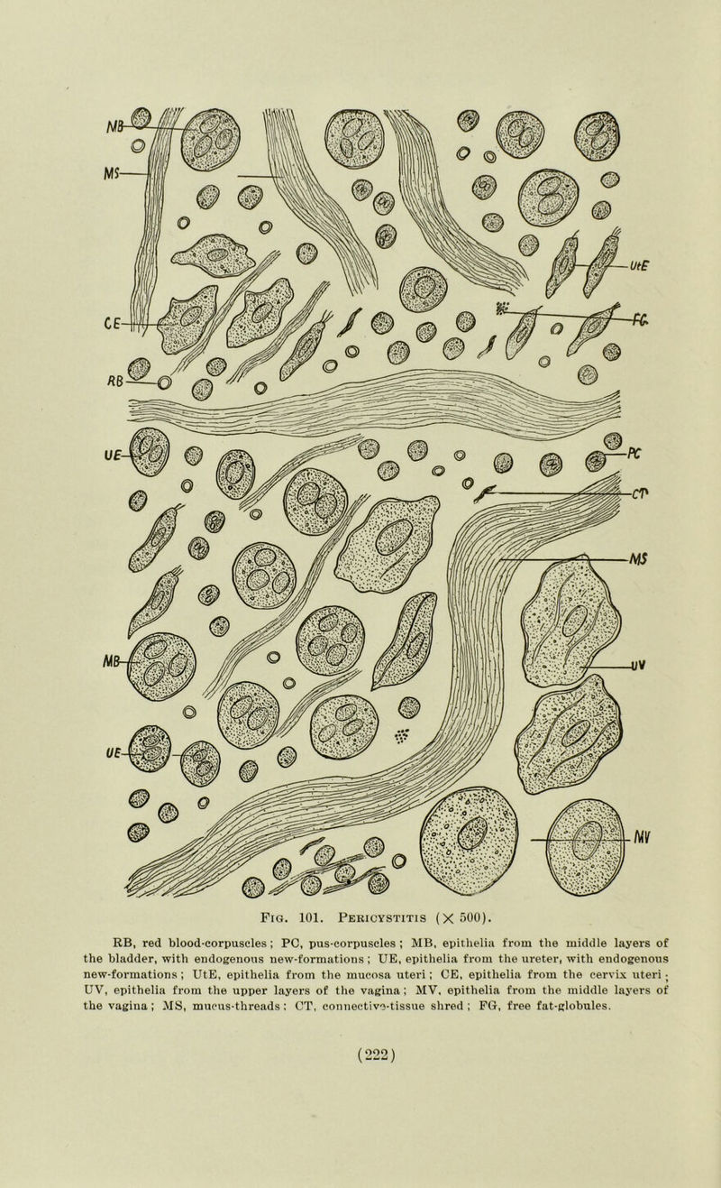 RB, red blood-corpuscles ; PC, pus-corpuscles ; MB, epithelia from the middle layers of the bladder, with endogenous new-formations; UE, epithelia from the ureter, with endogenous new-formations ; UtE, epithelia from the mucosa uteri; OE, epithelia from the cervix uteri; UV, epithelia from the upper layers of the vagina; MV, epithelia from the middle layei's of the vagina; MS, mucus-threads: CT, connective-tissue shred; FG, free fat-globules. {ooo \