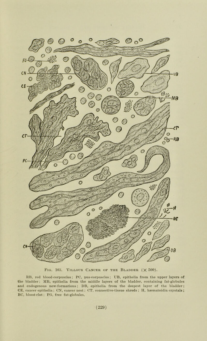 Fig. 10:5. Villous Cancer of the Bladder (X 500). RB, red blood-corpuscles ; PC, xjus-corpuscles ; UB, epithelia from the upper layers of the bladder; MB, epithelia from the middle layei’s of the bladder, containing fat-globules and endogenous new-formations ; DB, epithelia from the deepest layer of the bladder; CE, cancer epithelia : CN, cancer nest; CT, connective-tissue shreds; H, haematoidin crystals ; BC, blood-clot; F(f, free fat-globules.