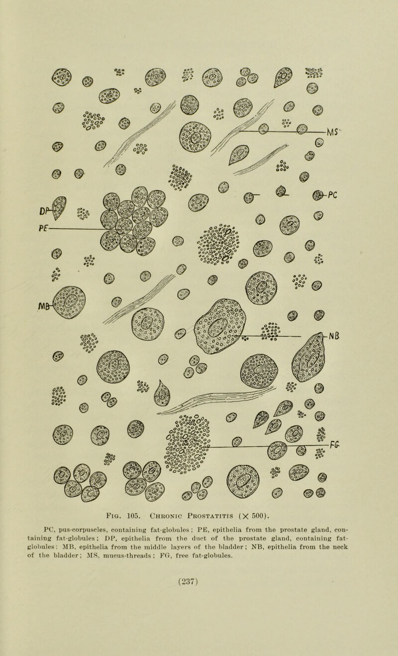 PC, pus-corpuscles, containing fat-globules ; PE, epithelia from the prostate gland, con- taining fat-globules; DP, epithelia from the duct of the pi’ostate gland, containing fat- globules; MB, epithelia from the middle layers of the bladder; NB, epithelia from the neck of the bladder; M.S, mucus-threads ; FD, free fat-globules.