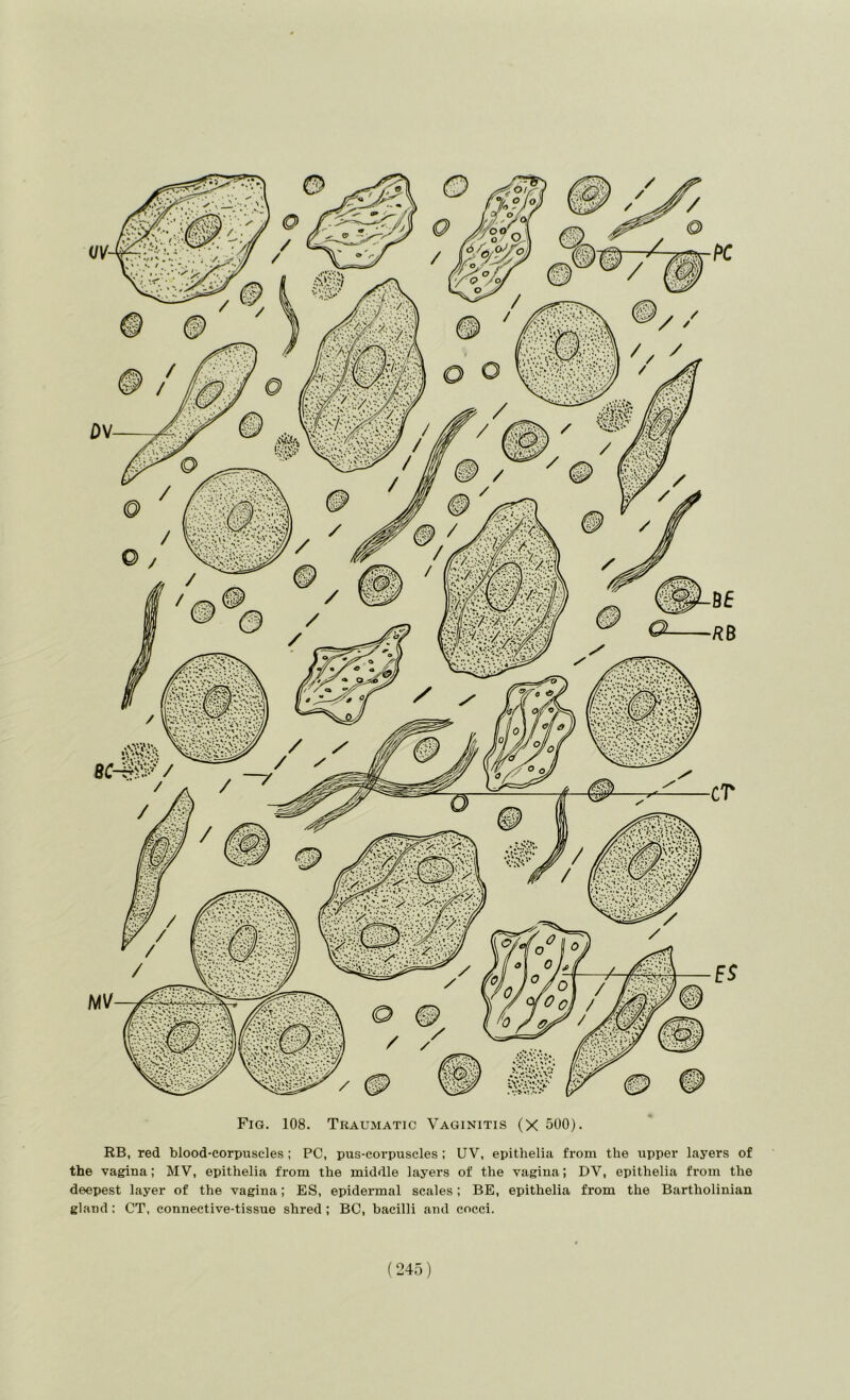 Fig. 108. Traumatic Vaginitis (X 500). RB, red blood-corpuscles; PC, pus-corpuscles ; UV, epithelia from the upper layers of the vagina; MV, epithelia from the middle layers of the vagina; DV, epithelia from the deepest layer of the vagina; ES, epidermal scales; BE, epithelia from the Bartholinian gland : CT, connective-tissue shred; BC, bacilli and cocci.