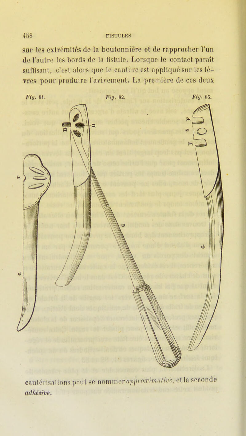 sur les extrémités de la boutonnière et de ropproclier l'un do l'autre les bords de la fistule. Lorsque le contact paraît suffisaiil, c'est alors que le cautère est appliqué sur les lè- vres pour produire l aviveuient. La première de ces deux fig. 8<. Fig. 82. Fig. 83. adhésive.