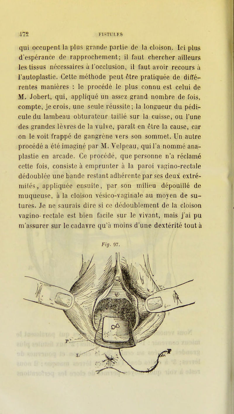 qui occupent la plus grandi» partie do la cloison. Ici plus d'espérance de rapprochement; il faut chercher ailleurs les tissus nécessaires à l'occlusion, il faut avoir recours à l'autoplastie. Cette méthode peut être pratiquée de diffé- rentes manières : le procédé le plus connu est celui de M, Jobert, qui, appliqué un assez grand nombre de fois, compte, je crois, une seule réussite; la longueur du pédi- cule du lambeau obturateur taillé sur la cuisse, ou l'une des grandes lèvres de la vulve, paraît en être la cause, car on le voit frappé de gangrène vers son sommet. Un autre procédé a été imaginé par M. Velpeau, qui l'a nommé ana- plastie en arcade. Ce procédé, que personne n'a réclamé cette fois, consiste à emprunter à la paroi vagino-rectale dédoublée une bande restant adhérente par ses deux extré- milés, appliquée ensuite, par son milieu dépouillé de muqueuse, à la cloison vésico-vaginale au moyen de su- tures. Je ne saurais dire si ce dédoublement de la cloison vagino- rectale est bien facile sur le vivant, mais j'ai pu m'assurer sur le cadavre qu'à moins d'une dextérité tout à Vig. 07.