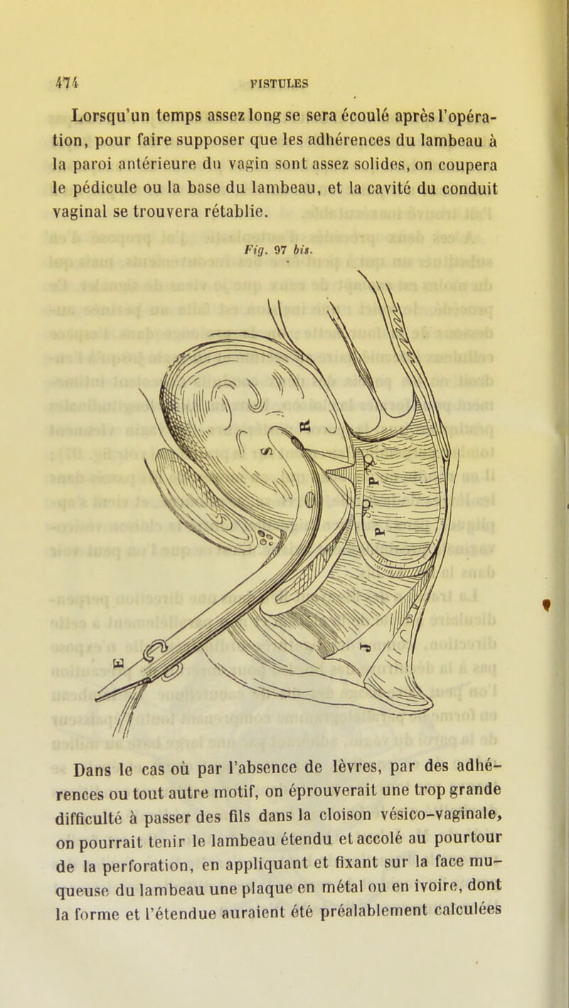 Lorsqu'un temps assez long se sera écoulé après l'opéra- tion, pour faire supposer que les adhérences du lambeau à la paroi antérieure du vagin sont assez solides, on coupera le pédicule ou la base du lambeau, et la cavité du conduit vaginal se trouvera rétablie. Fig. 97 bis. Dans le cas oîi par l'absence de lèvres, par des adhé- rences ou tout autre motif, on éprouverait une trop grande difficulté à passer des fils dans la cloison vésico-vaginale, on pourrait tenir le lambeau étendu et accolé au pourtour de la perforation, en appliquant et fixant sur la face mu- queuse du lambeau une plaque en métal ou en ivoire, dont la forme et l'étendue auraient été préalablement calculées