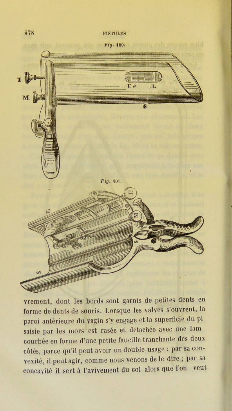 vrement, dont les bords sont garnis de petites dents en forme de dents de souris. Lorsque les valves s'ouvrent, la paroi antérieure du vagin s'y engage et la superficie du pl saisie par les mors est rasée et détachée avec une lam courbée en forme d'une petite faucille tranchante des deux côtés, parce qu'il peut avoir un double usage : par sa con- vexité, il peut agir, comme nous venons de le dire ; par sa concavité il sert à l'avivement du col alors que l'on veut