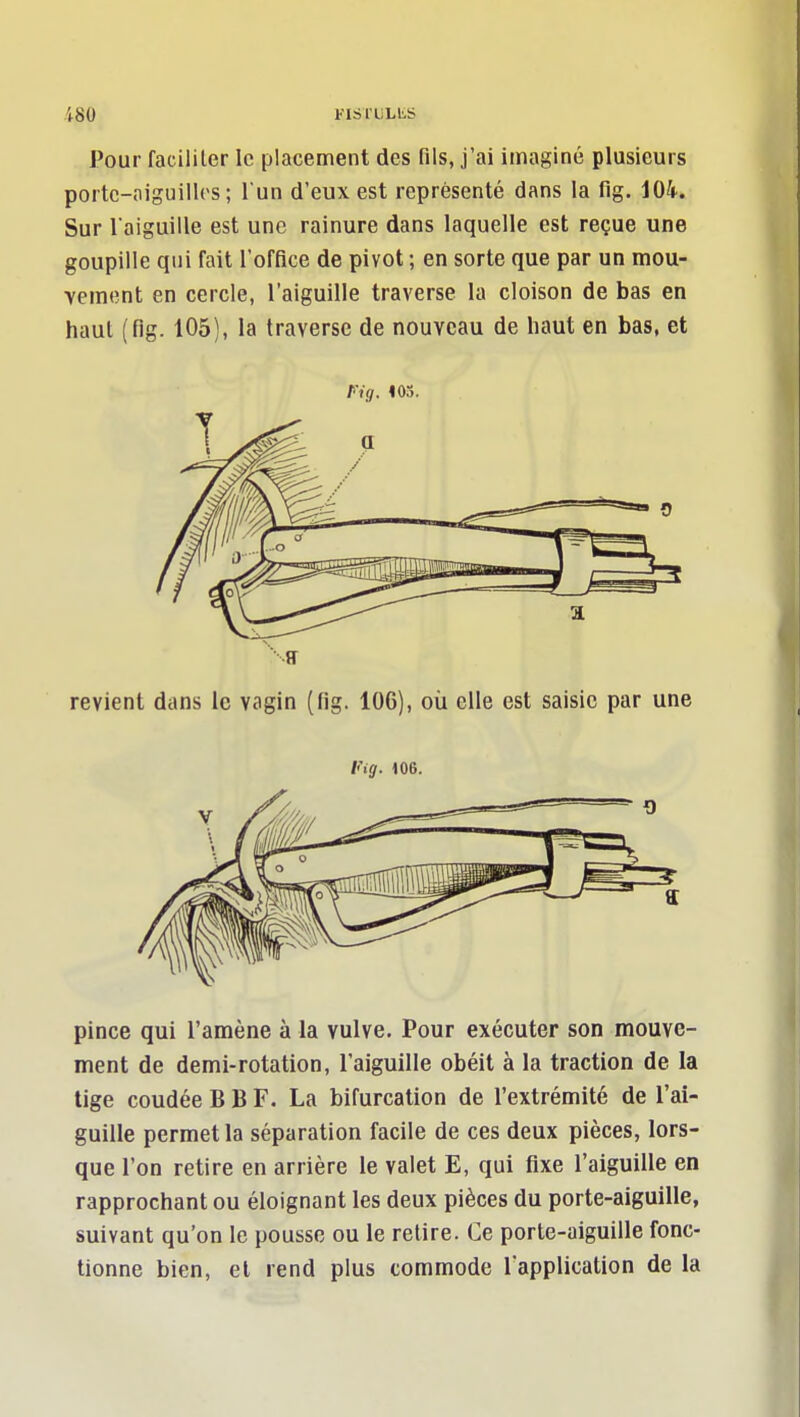 Pour facililer le placement des fils, j'ai imaginé plusieurs portc-niguiilos ; l'un d'eux est représenté dans la fig. 104. Sur l'aiguille est une rainure dans laquelle est reçue une goupille qui fait l'office de pivot ; en sorte que par un mou- vement en cercle, l'aiguille traverse la cloison de bas en haut (fig. 105), la traverse de nouveau de haut en bas, et revient dans le vagin (fig. 106), où elle est saisie par une Fig. 106. pince qui l'amène à la vulve. Pour exécuter son mouve- ment de demi-rotation, l'aiguille obéit à la traction de la tige coudée B B F. La bifurcation de l'extrémité de l'ai- guille permet la séparation facile de ces deux pièces, lors- que l'on retire en arrière le valet E, qui fixe l'aiguille en rapprochant ou éloignant les deux pièces du porte-aiguille, suivant qu'on le pousse ou le retire. Ce porte-aiguille fonc- tionne bien, et rend plus commode l'application de la