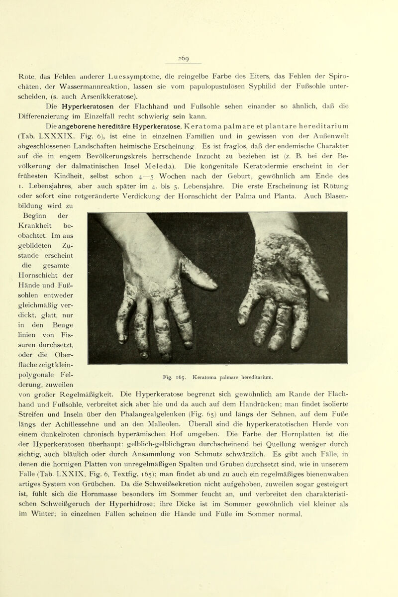 26g Röte, das Fehlen anderer Lues Symptome, die reingelbe Farbe des Eiters, das Fehlen der Spiro- chäten, der Wassermannreaktion, lassen sie vom papulopustulösen Syphilid der Fußsohle unter- scheiden, (s. auch Arsenikkeratose). Die Hyperkeratosen der Flachhand und Fußsohle sehen einander so ähnlich, daß die Differenzierung' im Einzelfall recht schwierig sein kann. Die angeborene hereditäre Hyperkeratose, Keratoma palmare et plantare hereditarium (Tab. LXXXIX, Fig. 6), ist eine in einzelnen Familien und in gewissen von der Außenwelt abgeschlossenen Landschaften heimische Erscheinung. Es ist fraglos, daß der endemische Charakter auf die in engem Bevölkerungskreis herrschende Inzucht zu beziehen ist (z. B. bei der Be- völkerung der dalmatinischen Insel Meleda). Die kongenitale Keratodermie erscheint in der frühesten Kindheit, selbst schon 4—5 Wochen nach der Geburt, gewöhnlich am Ende des I. Lebensjahres, aber auch später im 4. bis 5. Lebensjahre. Die erste Erscheinung ist Rötung oder sofort eine rotgeränderte Verdickung der Hornschicht der Palma und Planta. Auch Blasen- bildung wird zu Beginn der Krankheit be- obachtet. Im aus gebildeten Zu- stande erscheint die gesamte Hornschicht der Hände und Fuß- sohlen entweder gleichmäßig ver- dickt, glatt, nur in den Beuge linien von Fis- suren durchsetzt, oder die Ober- fläche zeigt klein- polygonale Fel- derung, zuweilen von großer Regelmäßigkeit. Die Hyperkeratose begrenzt sich gewöhnhch am Rande der Flach- hand und Fußsohle, verbreitet sich aber hie und da auch auf dem Handrücken; man findet isolierte Streifen und Inseln über den Phalangealgelenken (Fig. 65) und längs der Sehnen, auf dem Fuße längs der Achillessehne und an den Malleolen. Uberall sind die hyperkeratotischen Herde von einem dunkelroten chronisch hyperämischen Hof umgeben. Die Farbe der Hornplatten ist die der Hyperkeratosen überhaupt: gelblich-gelblichgrau durchscheinend bei Quellung weniger durch sichtig, auch bläulich oder durch Ansammlung von Schmutz schwärzlich. Es gibt auch Fälle, in denen die hornigen Platten von unregelmäßigen Spalten und Gruben durchsetzt sind, wie in unserem artiges System von Grübchen. Da die Schweißsekretion nicht aufgehoben, zuweilen sogar gesteigert ist, fühlt sich die Hornmasse besonders im Sommer feucht an, und verbreitet den charakteristi- schen Schweißgeruch der Hyperhidrose; ihre Dicke ist im Sommer gewöhnlich viel kleiner als im Winter; in einzelnen Fällen scheinen die Hände und Füße im Sommer normal. Fig. 165. Keratoma palmare hereditarium.