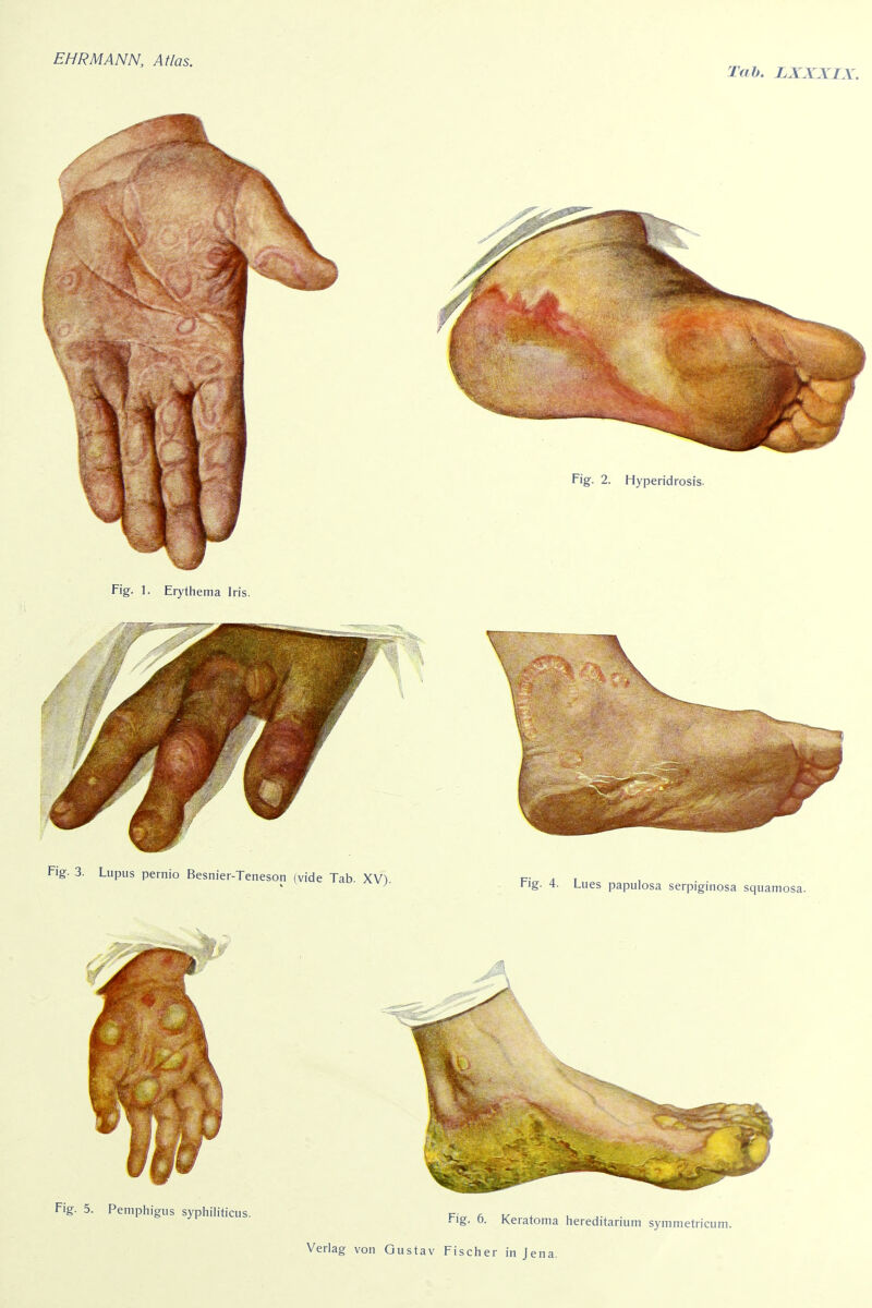 Tab. LXXXIX. Fig. 1. Erythema Iris. Fig. 5. Pemphigus syphiliticus. F,„ fi 1/ . u j-. • •^'g- 0- Keratoma hereditanum symmetricum.