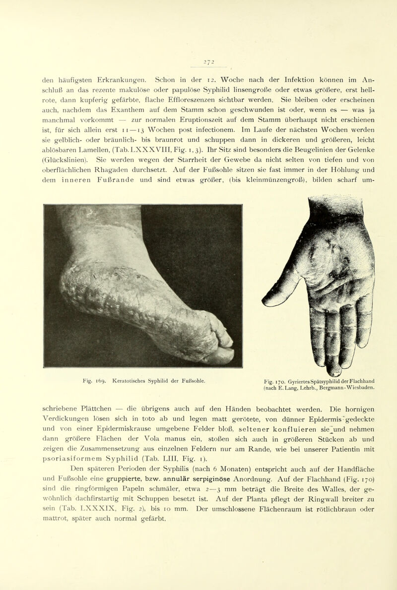 den häufigsten Erkrankungen. Schon in der 12. Woche nach der Infektion können im An- schluß an das rezente makulöse oder papulöse Syphilid linsengroße oder etwas größere, erst hell- rote, dann kupferig gefärbte, flache Effloreszenzen sichtbar werden. Sie bleiben oder erscheinen auch, nachdem das Exanthem auf dem Stamm schon geschwunden ist oder, wenn es — was ja manchmal vorkommt — zur normalen Eruptionszeit auf dem Stamm überhaupt nicht erschienen ist, für sich allein erst 11 —13 Wochen post infectionem. Im Laufe der nächsten Wochen werden sie gelblich- oder bräunlich- bis braunrot und schuppen dann in dickeren und größeren, leicht ablösbaren Lamellen, (Tab. LXXXVIII, Fig. i, 3). Ihr Sitz sind besonders die Beugelinien der Gelenke (Glückslinien). Sie werden wegen der Starrheit der Gewebe da nicht selten von tiefen und von oberflächlichen Rhagaden durchsetzt. Auf der Fußsohle sitzen sie fast immer in der Höhlung und dem inneren Fußrande und sind etwas größer, (bis kleinmünzengroß), bilden scharf um- Fig. 169. Keratotisches Syphilid der Fußsohle. i< ig. 170. GyriertesSpätsyphilid der Flachhand (nach E. Lang, Lehrb., Bergmann-Wiesbaden. schriebene Plättchen — die übrigens auch auf den Händen beobachtet werden. Die hornigen Verdickungen lösen sich in toto ab und legen matt gerötete, von dünner Epidermis'gedeckte und von einer Epidermiskrause umgebene Felder bloß, seltener konfluieren sie^und nehmen dann größere Flächen der Vola manus ein, stoßen sich auch in größeren Stücken ab und zeigen die Zusammensetzung aus einzelnen Feldern nur am Rande, wie bei unserer Patientin mit psoriasiformem Syphilid (Tab. LIII, Fig. i). Den späteren Perioden der Syphilis (nach 6 Monaten) entspricht auch auf der Handfläche und Fußsohle eine gruppierte, bzw. annulär serpiginöse Anordnung. Auf der Flachhand (Fig. 170) sind die ringförmigen Papeln schmäler, etwa 2 — 3 mm beträgt die Breite des Walles, der ge- wöhnlich dachfirstartig mit Schuppen besetzt ist. Auf der Planta pflegt der Ringwall breiter zu sein (Tab. LXXXIX, Fig. 2), bis 10 mm. Der umschlossene Flächenraum ist rötlichbraun oder mattrot, später auch normal gefärbt.