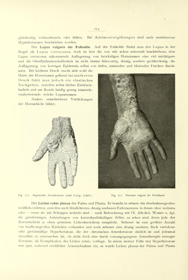 gleichzeitig Vorhandensein oder fehlen. Bei Antimon Vergiftungen sind auch membranöse Hyperkeratosen beschrieben worden. Der Lupus vulgaris der Fußsohle. Auf der Fußsohle findet man den Lupus in der Regel als Lupus verrucosus, doch ist hier die von mir schon seinerzeit beschriebene, dem Lupus verrucosus zukommende Auflagerung von bröckehgen Hornmassen eine viel mächtigere und die Oberflächenbeschaffenheit ist nicht immer feinv/arzig, drusig, sondern grobhöckerig, die Auflagerung von horniger Epidermis selbst von tiefen, nässenden und blutenden Furchen durch- setzt. Bei leichtem Druck macht sich wohl die Härte der Hornmassen geltend, bei stärkerem Druck fühlt man jedoch ein elastisches Nachgeben, zuweilen selbst leichte Eindrück- barkeit und am Rande häufig genug nässende, exulzerierende, weiche Lupusmassen. Andere umschriebene Verdickungen der Hornschicht bildet: ¥\g. i/i. Beginnende Arsenkeratose (nach Lang, Lehrb.). Fig. 172. Psoriasis vulgaris der Flachhand. Der Liehen ruber planus der Palma und Planta. Er besteht in erbsen- bis überbohnengroßen weißlich-violetten, zuweilen auch bläulichroten, drusig unebenen Exkreszenzen, in denen ohne weiteres oder — wenn sie mit Schuppen bedeckt sind — nach Befeuchtung mit Öl, Alkohol, Wasser u. dgl. die griesförmigen Anhäufungen von keratohyalinhaltigen Zellen zu sehen sind, deren jede der Körnerschicht je eines primären Lichenknötchens entspricht. Seltener ist eine größere Anzahl von hanfkorngroßen Knötchen vorhanden und noch seltener eine drusig unebene, flach verruköse oder gleichmäßige Hyperkeratose, die der chronischen Arsenkeratose ähnlich ist und jedesmal daraufhin zu untersuchen ist, ob nicht doch eine durch vorausgegangene Arsentherapie erzeugte Keratose, als Komplikation des Liehen ruber, vorliegt. In einem meiner Fälle trat Hyperkeratose erst spät, während reichlicher Arsenaufnahme ein, es wurde Liehen planus der Palma und Planta