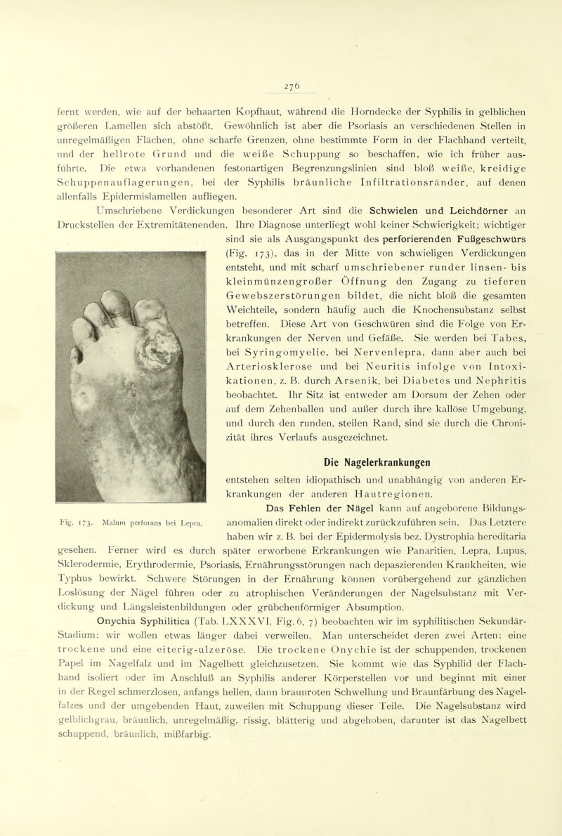 fernt werden, wie auf der behaarten Kopfhaut, während die Horndecke der Syphilis in gelblichen größeren Lamellen sich abstößt. Gewöhnlich ist aber die Psoriasis an verschiedenen Stellen in unregelmäßigen Flächen, ohne scharfe Grenzen, ohne bestimmte Form in der Flachhand verteilt, und der hellrote Grund und die weiße Schuppung so beschaffen, wie ich früher aus- führte. Die etwa vorhandenen festonartigen Begrenzungslinien sind bloß weiße, kreidige Schuppenauflagerungen, bei der Syphilis bräunliche Infiltrationsränder, auf denen allenfalls Epidermislamellen aufliegen. Umschriebene Verdickungen besonderer Art sind die Schwielen und Leichdörner an Druckstellen der Extremitätenenden. Ihre Diagnose unterliegt wohl keiner Schwierigkeit; wichtiger sind sie als Ausgangspunkt des perforierenden Fußgeschwürs (Fig. 173), das in der Mitte von schwieligen Verdickungen entsteht, und mit scharf umschriebener runder linsen- bis kleinmünzengroßer Öffnung den Zugang zu tieferen Gewebszerstörungen bildet, die nicht bloß die gesamten Weichteile, sondern häufig auch die Knochensubstanz selbst betreffen. Diese Art von Geschwüren sind die Folge von Er- krankungen der Nerven und Gefäße. Sie werden bei Tabes, bei Syringomyelie, bei Nervenlepra, dann aber auch bei Arteriosklerose und bei Neuritis infolge von Intoxi- kationen, z. B. durch Arsenik, bei Diabetes und Nephritis beobachtet. Ihr Sitz ist entweder am Dersum der Zehen oder auf dem Zehenballen und außer durch ihre kailöse Umgebung, und durch den runden, steilen Rand, sind sie durch die Chroni- zität ihres Verlaufs ausgezeichnet. Die Nagelerkrankungen entstehen selten idiopathisch und unabhängig von anderen Er- krankungen der anderen Hautregionen. Das Fehlen der Nägel kann auf angeborene Bildungs- Fig. 173. Malum perforaiis bei Lepra. anomalien direkt oder indirekt Zurückzuführen sein. Das Letztere haben wir z. B. bei der Epidermolysis bez. Dystrophia hereditaria gesehen. Ferner wird es durch später erworbene Erkrankungen wie Panaritien, Lepra, Lupus, Sklerodermie, Erythrodermie, Psoriasis, Ernährungsstörungen nach depaszierenden Krankheiten, wie Typhus bewirkt. Schwere Störungen in der Ernährung können vorübergehend zur gänzlichen Loslösung der Nägel führen oder zu atrophischen Veränderungen der Nagelsubstanz mit Ver- dickung und Längsleistenbildungen oder grübchenförmiger Absumption. Onychia Syphilitica (Tab. LXXXVI, Fig. 6, 7) beobachten wir im syphilitischen Sekundär- Stadium: wir wollen etwas länger dabei verweilen. Man unterscheidet deren zwei Arten: eine trockene und eine eiterig-ulzeröse. Die trockene Onychie ist der schuppenden, trockenen Papel im Nagelfalz und im Nagelbett gleichzusetzen. Sie kommt wie das Syphilid der Flach- hand isoliert oder im Anschluß an Syphilis anderer Körperstellen vor und beginnt mit einer in der Regel schmerzlosen, anfangs hellen, dann braunroten Schwellung und Braunfärbung des Nagel- falzes und der umgebenden Haut, zuweilen mit Schuppung dieser Teile. Die Nagelsubstanz wird gelblichgrau, bräunlich, unregelmäßig, rissig, blätterig und abgehoben, darunter ist das Nagelbett schuppend, bräunlich, mißfarbig.