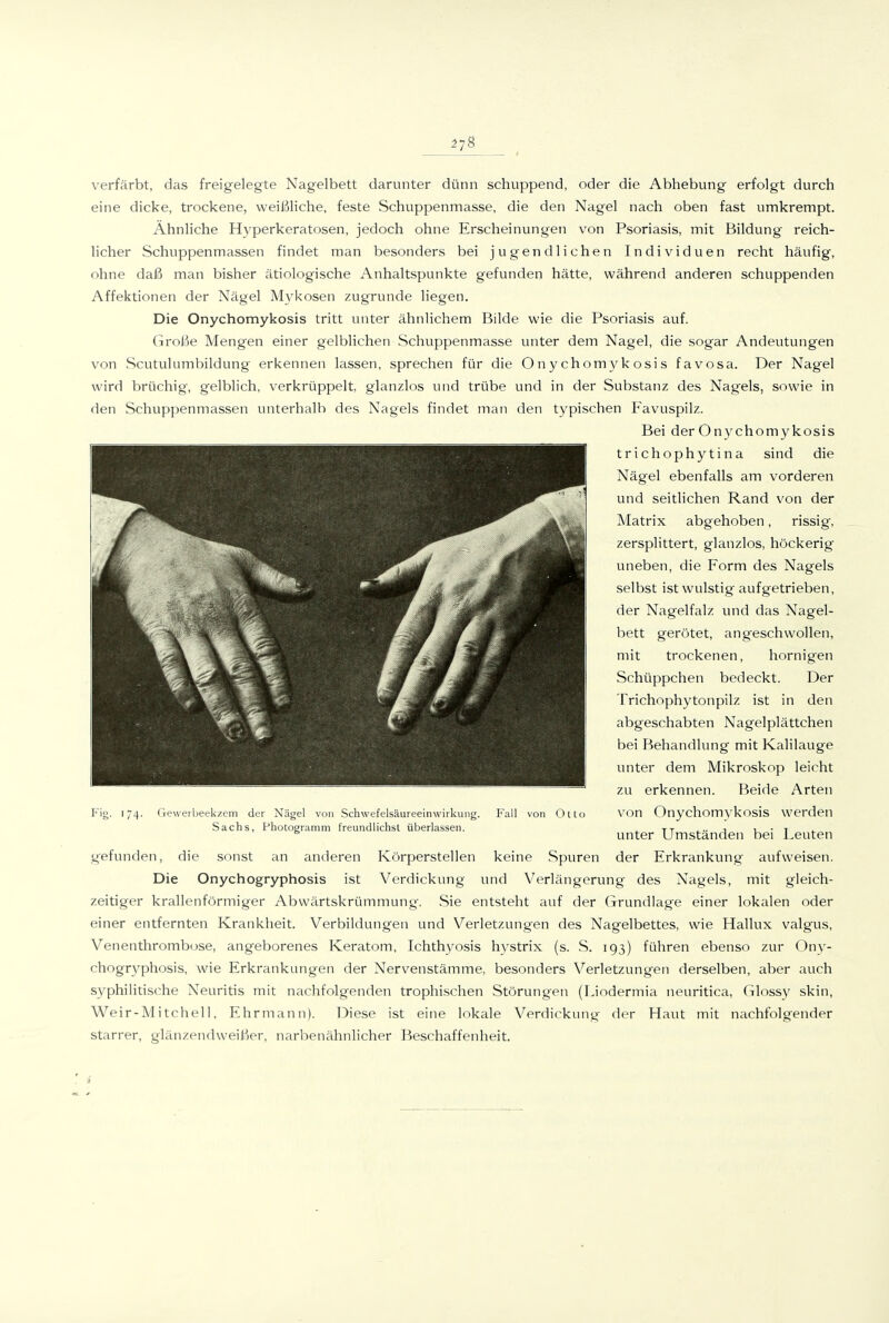 verfärbt, das freigelegte Nagelbett darunter dünn schuppend, oder die Abhebung erfolgt durch eine dicke, trockene, weißliche, feste Schuppeninasse, die den Nagel nach oben fast umkrempt. Ahnliche Hyperkeratosen, jedoch ohne Erscheinungen von Psoriasis, mit Bildung reich- licher Schuppenmassen findet man besonders bei jugendlichen Individuen recht häufig, ohne daß man bisher ätiologische Anhaltspunkte gefunden hätte, während anderen schuppenden Affektionen der Nägel Mykosen zugrunde liegen. Die Onychomykosis tritt unter ähnlichem Bilde wie die Psoriasis auf. Große Mengen einer gelblichen Schuppenmasse unter dem Nagel, die sogar Andeutungen von Scutulumbildung erkennen lassen, sprechen für die Onychom3^kosis favosa. Der Nagel wird brüchig, gelblich, verkrüppelt, glanzlos und trübe und in der Substanz des Nagels, sowie in den Schuppenmassen unterhalb des Nagels findet man den typischen Favuspilz. Bei der Onychomykosis trichophytina sind die Nägel ebenfalls am vorderen und seitlichen Rand von der Matrix abgehoben, rissig, zersplittert, glanzlos, höckerig uneben, die Form des Nagels selbst ist wulstig aufgetrieben, der Nagelfalz und das Nagel- bett gerötet, angeschwollen, mit trockenen, hornigen Schüppchen bedeckt. Der Trichophytonpilz ist in den abgeschabten Nagelplättchen bei Behandlung mit Kalilauge unter dem Mikroskop leicht zu erkennen. Beide Arten Fig. 174. Geweibeekzem der Nägel von Schwefelsäureeinwirkuiig. Fall von Otto VOn Onychomykosis werden Sachs, Photogramm freundlichst überlassen. . tt j u • t ^ unter Umstanden bei Leuten gefunden, die sonst an anderen Körperstellen keine Spuren der Erkrankung aufweisen. Die Onychogryphosis ist Verdickung und Verlängerung des Nagels, mit gleich- zeitiger krallenförmiger Abwärtskrümmung. Sie entsteht auf der Grundlage einer lokalen oder einer entfernten Krankheit. Verbildungen und Verletzungen des Nagelbettes, wie Hallux valgus, Venenthrombose, angeborenes Keratom, Ichthyosis hystrix (s. S. 193) führen ebenso zur Ony- chogryphosis, wie Erkrankungen der Nervenstämme, besonders Verletzungen derselben, aber auch syphilitische Neuritis mit nachfolgenden trophi.schen Störungen (Liodermia neuritica, Glossy skin, W^eir-Mitchell, Ehrmann). Diese ist eine lokale Verdickung der Haut mit nachfolgender starrer, glänzendweißer, narbenähnlicher Beschaffenheit.