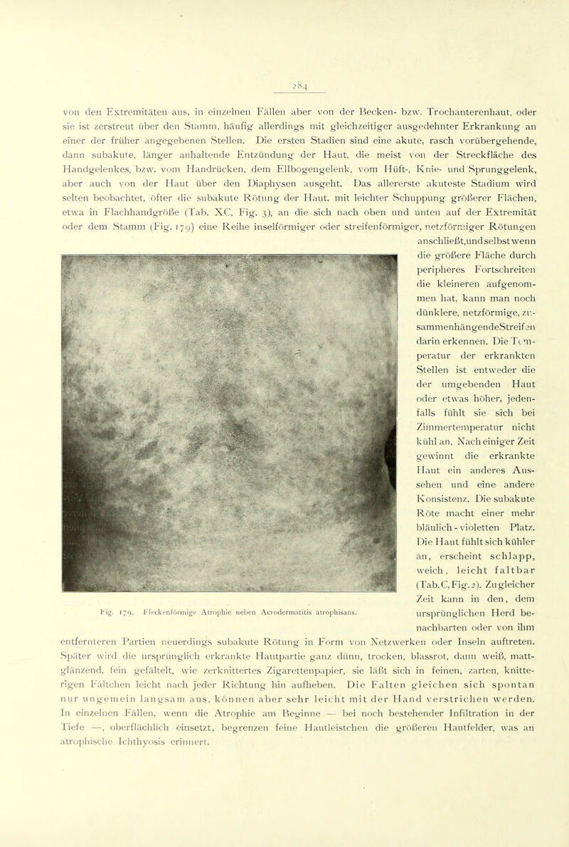 von den Extremitäten aus, in einzelnen Fällen aber von der Becken- bzw. Trochanterenhaut, oder sie ist zerstreut über den Stamm, häufig allerdings mit gleichzeitiger ausgedehnter Erkrankung an einer der früher ang'egebenen Stellen. Die ersten Stadien sind eine akute, rasch vorübergehende, dann subakute, länger anhaltende Entzündung der Haut, die meist von der Streckfläche des Handgelenkes, bzw. vom Handrücken, dem Ellbogengelenk, vom Hüft-, Knie- und Sprunggelenk, aber auch von der Haut über den Diaphysen ausgeht. Das allererste akuteste Stadium wird selten beobachtet, öfter die subakute Rötung der Haut, mit leichter Schuppung größerer Flächen, etwa in Flachhandgröße (Tab. XC, Fig. 3), an die sich nach oben und unten auf der Extremität oder dem Stamm (Fig. 17g) eine Reihe inselförmiger oder streifenförmiger, netzförmiger Rötungen anschließt,und selbst wenn die gTöIi^ere Fläche durch peripheres Fortschreiten die kleineren aufgenom- men hat, kann man noch dünklere, netzförmige, zu- sammenhängendeStreif en darin erkennen. Die Tem- peratur der erkrankten Stellen ist entweder die der umgebenden Haut oder etwas höher, jeden- falls fühlt sie sich bei Zimmertemperatur nicht kühl an. Nach einiger Zeit gewinnt die erkrankte Flaut ein anderes Aus- sehen und eine andere Konsistenz. Die subakute Röte macht einer mehr bläulich - violetten Platz. Die Haut fühlt sich kühler an, erscheint schlapp, weich, leicht faltbar (Tab.C, Fig. 2). Zu gleicher Zeit kann in den, dem ursprünglichen Herd be- nachbarten oder von ihm entfernteren Partien neuerdings subakute Rötung in F'orm von Netzwerken oder Inseln auftreten. Später wird die ursprünglich erkrankte Hautpartie ganz dünn, trocken, blassrot, dann weiß, matt- glänzend, fein gefältelt, wie zerknittertes Zigarettenpapier, sie läßt sich in feinen, zarten, knitte- rigen Fältchen leicht nach jeder Richtung hin aufheben. Die Falten gleichen sich spontan nur ungeiuein langsam aus, können aber sehr leicht mit der Hand verstrichen werden. In einz(?lnen Fällen, wenn die Atrophie am Beginne — bei noch bestehender Infiltration in der Tiefe —, oberflächlich einsetzt, begrenzen feine Haulleistchen die größeren Hautfelder, was an atrophische Ichthyosis erinnert. l'ig- '79- Fleckenförniige Atrophie neben Acrodermatitis atrophisans.
