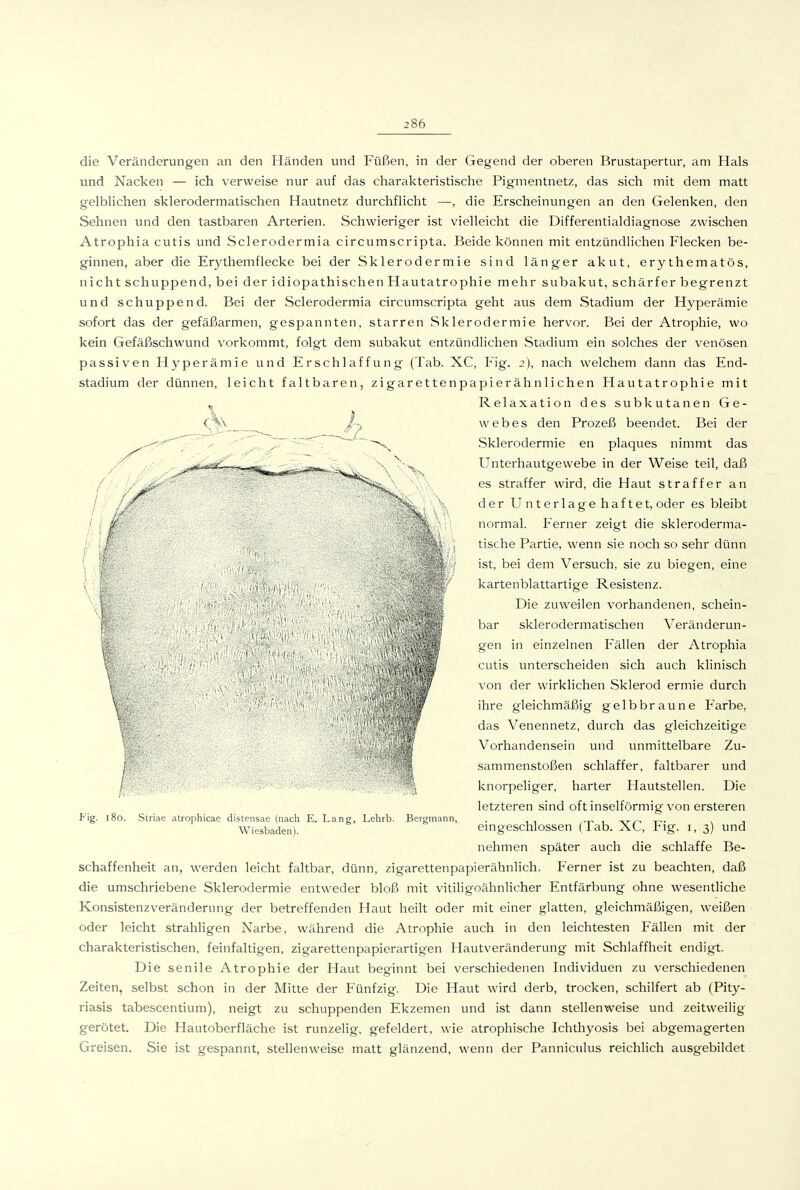 die Veränderungen an den Händen und Füßen, in der Gegend der oberen Brustapertur, am Hals und Nacken — ich verweise nur auf das charakteristische Pigmentnetz, das sich mit dem matt gelblichen sklerodermatischen Hautnetz durchflicht —, die Erscheinvmgen an den Gelenken, den Sehnen und den tastbaren Arterien. Schwieriger ist vielleicht die Differentialdiagnose zwischen Atrophia cutis und Sclerodermia circumscripta. Beide können mit entzündlichen Flecken be- ginnen, aber die Erythemflecke bei der Sklerodermie sind länger akut, erythematös, nicht schuppend, bei der idiopathischen Hautatrophie mehr subakut, schärfer begrenzt und schuppend. Bei der Sclerodermia circumscripta geht aus dem Stadium der Hyperämie sofort das der gefäßarmen, gespannten, starren Sklerodermie hervor. Bei der Atrophie, wo kein Gefäßschwund vorkommt, folgt dem subakut entzündlichen Stadium ein solches der venösen passiven Hyperämie und Erschlaffung (Tab. XC, Fig. 2), nach welchem dann das End- stadium der dünnen, leicht faltbaren, zigarettenpapierähnlichen Hautatrophie mit „ Relaxationdessubl<utanenGe- web es den Prozeß beendet. Bei der Sklerodermie en plaques nimmt das Unterhautgewebe in der Weise teil, daß es straffer wird, die Haut straffer an der Unterlage haftet, oder es bleibt normal. Ferner zeigt die skleroderma- tische Partie, wenn sie noch so sehr dünn ist, bei dem Versuch, sie zu biegen, eine ]<artenblattartige Resistenz. Die zuweilen vorhandenen, schein- bar sklerodermatischen Veränderun- gen in einzelnen Fällen der Atrophia cutis unterscheiden sich auch klinisch von der wirklichen Sklerod ermie durch ihre gleichmäßig gelbbraune Farbe, das Venennetz, durch das gleichzeitige Vorhandensein und unmittelbare Zu- sammenstoßen schlaffer, faltbarer und knorpeliger, harter Hautstellen. Die letzteren sind oft inselförmig von ersteren eingeschlossen (Tab. XC, Fig. 1, 3) und nehmen später auch die schlaffe Be- schaffenheit an, werden leicht faltbar, dünn, zigarettenpapierähnlich. Ferner ist zu beachten, daß die umschriebene Sklerodermie entweder bloß mit vitiligoähnlicher Entfärbung ohne wesentliche Konsistenzveränderung der betreffenden Haut heilt oder mit einer glatten, gleichmäßigen, weißen oder leicht strahligen Narbe, während die Atrophie auch in den leichtesten Fällen mit der charakteristischen, feinfaltigen, zigarettenpapierartigen Hautveränderung mit Schlaffheit endigt. Die senile Atrophie der Haut beginnt bei verschiedenen Individuen zu verschiedenen Zeiten, selbst schon in der Mitte der Fünfzig. Die Haut wird derb, trocken, schilfert ab (Pity- riasis tabescentium), neigt zu schuppenden Ekzemen und ist dann stellenweise und zeitweilig gerötet Die Hautoberfläche ist runzelig, gefeldert, wie atrophische Ichthyosis bei abgemagerten Greisen. Sie ist gespannt, stellenweise matt glänzend, wenn der Pannicnlus reichlich ausgebildet Fig. 180. Striae atrophicae distensae (nach E. Lang, Lehrb Wiesbaden). Bergmann,