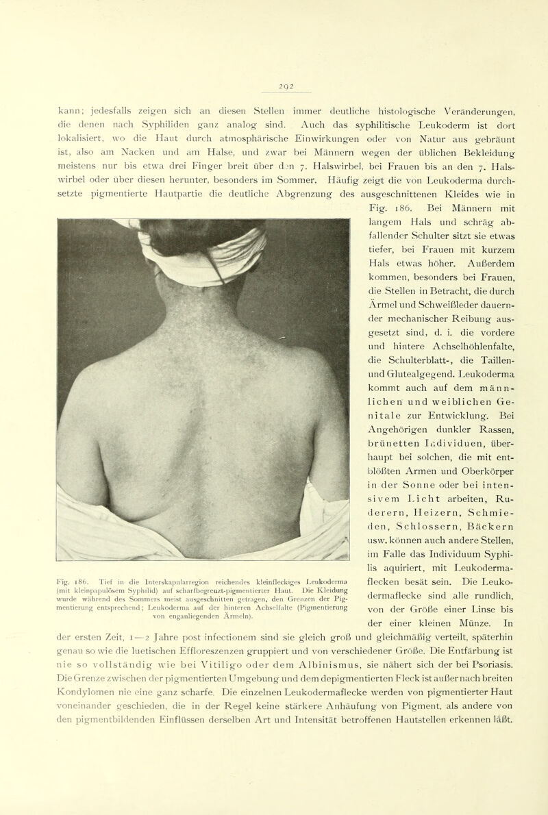 2g2 kann; jedesfalls zeigen sich an diesen Stellen immer deutliche histologische Veränderungen, die denen nach Syphiliden ganz analog sind. Auch das syphilitische Leukoderm ist dort lokalisiert, wo die Haut durch atmosphärische Einwirkungen oder von Natur aus gebräunt ist, also am Nacken und am Halse, und zwar bei Männern wegen der üblichen Bekleidung meistens nur bis etwa drei Finger breit über d_>n 7. Halswirbel, bei Frauen bis an den 7. Hals- wirbel oder über diesen herunter, besonders im Sommer. Häufig zeigt die von Leukoderma durch- setzte pigmentierte Hautpartie die deutliche Abgrenzung des ausgeschnittenen Kleides wie in Fig. 186. Bei Männern mit langem Hals und schräg ab- fallender Schulter sitzt sie etwas tiefer, bei P>auen mit kurzem Hals etwas höher. Außerdem kommen, besonders bei Frauen, die Stellen in Betracht, die durch Ärmel und Schweißleder dauern- der mechanischer Reibung aus- gesetzt sind, d. i. die vordere und hintere Achsel höhlen falte, die Schulterblatt-, die Taillen- und Glutealgegend. Leukoderma kommt auch auf dem männ- lichen und weiblichen Ge- nitale zur Entwicklung. Bei Angehörigen dunkler Rassen, brünetten ludividuen, über- haupt bei solchen, die mit ent- blößten Armen und Oberkörper in der Sonne oder bei inten- sivem Licht arbeiten, Ru- derern, Heizern, Schmie- den, Schlossern, Bäckern usw. können auch andere Stellen, im Falle das Individuum Syphi- lis aquiriert, mit Leukoderma- flecken besät sein. Die Leuko- dermaflecke sind alle rundlich, von der Größe einer Linse bis der einer kleinen Münze. In der ersten Zeit, 1—2 Jahre post infectionem sind sie gleich groß und gleichmäßig verteilt, späterhin genau so wie die luetischen Effloreszenzen gruppiert und von verschiedener Größe. Die Entfärbung ist nie so vollständig' wie bei Vitiligo oder dem Albinismus, sie nähert sich der bei Psoriasis. Die Grenze zwischen der pigmentierten Umgebung und dem depigmentierten Fleck ist außer nach breiten Kondylomen nie eine ganz scharfe. Die einzelnen Leukodermaflecke werden von pigmentierter Haut voneinander geschieden, die in der Regel keine stärkere Anhäufung von Pigment, als andere von den pigmentbildenden Einflüssen derselben Art und Intensität betroffenen Hautstellen erkennen läßt. Fig. (mit [86. Tief in die Intersliapularregion reichendes Icleinfleckiges Leukoderma ileinpapulösem Sypliilid) auf scliarfbegreuzt-pigmeiitierter Hanl. Die Kleidung wurde während des Sommers meist ausgeschnitten getragen, den Grenzen der Pig- mentieriuig entsprechend; Leukoderma auf der hinteren Achselfalte (Pigmentierung von enganliegenden Ärmeln).
