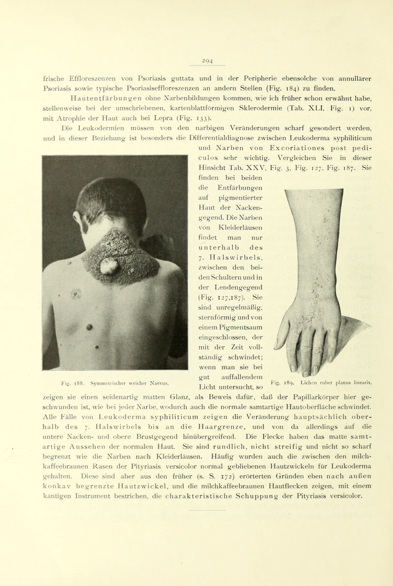 frische Effloreszenzen von Psoriasis guttata und in der Peripherie ebensolche von annullärer Psoriasis sowie typische Psoriasiseffloreszenzen an andern Stellen (Fig. 184) zu finden. Hautentfärbungen ohne Narbenbildungen kommen, wie ich früher schon erwähnt habe, stellenweise bei der umschriebenen, kartenblattförmigen Sklerodermie (Tab. XLI, Fig. i) vor, mit Atrophie der Haut auch bei Lepra (Fig. 133). Die Leukodermien müssen von den narbigen Veränderungen scharf gesondert werden, und in dieser Beziehung ist besonders die Differentialdiagnose zwischen Leukoderma syphiliticum und Narben von Excoriati ones post pedi- culos sehr wichtig. Vergleichen Sie in dieser Hinsicht Tab. XXV, Fig'. 3, Fig. 127, Fig. 187. Sie finden bei beiden die Entfärbungen auf pigmentierter Haut der Nacken- gegend. Die Narben von Kleiderläusen findet man nur unterhalb des 7. Halswirbels, zwischen den bei- den Schultern und in der Lendengegend (Fig. 127,187). Sie sind unregelmäßig, sternförmig und von einem Pigmentsaum eingeschlossen, der mit der Zeit voll- ständig schwindet; wenn man sie bei gut auffallendem Licht untersucht, so zeigen sie einen seidenartig matten Glanz, als Beweis dafür, daß der Papillarkörper hier ge- schwunden ist, wie bei jeder Narbe, wodurch auch die normale samtartige Hautoberfläche schwindet. Alle Fälle von Leukoderma syphiliticum zeig'en die Veränderung hauptsächlich ober- halb des 7. Halswirbels bis an die Haargrenze, und von da allerdings auf die untere Nacken- und obere Brustgegend hinübergreifend. Die Flecke haben das matte samt- artige Aussehen der normalen Haut. Sie sind rundlich, nicht streifig und nicht so scharf begrenzt wie die Narben nach Kleiderläusen. Häufig wurden auch die zwischen den milch- kaffeebraunen Rasen der Pityriasis versicolor normal gebliebenen Hautzwickeln für Leukoderma gehalten. Diese sind aber aus den früher (s. S. 172) erörterten Gründen eben nach außen konkav begrenzte Hautzwickel, und die milchkaffeebraunen Hautfiecken zeigen, mit einem kantigen Instrument bestrichen, die charakteristische Schuppung der Pityriasis versicolor. Fig. 188. Symmetrischer weicher Naevus. Fig. 189. Liehen ruber planus linearis.