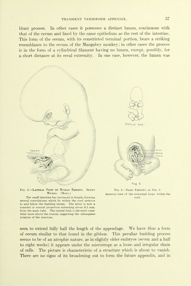 bliint process. In other cases it possesses a distinct lumen, continuous with that of the cecum and hned by the same epithehum as the rest of the intestine. This form of the cecum, with its constricted terminal portion, bears a striking resemblance to the cecum of the Mangabey monkey; in other cases the process is in the form of a cylindrical filament having no lumen, except, possibly, for a short distance at its cecal extremity. In one case, however, the lumen was several convolutions which lie within the cord anterior to and below the budding cecum. The latter is now a rounded or conical projection extending about 0.5 mm. from the main tube. The caudal limb is elevated some- what more above the cranial, suggesting the subsequent rotation of the intestine. seen to extend fully half the length of the appendage. We have thus a form of cecum similar to that found in the gibbon. This peculiar budding process seems to be of an atrophic nature, as in slightly older embryos (seven and a half to eight weeks) it appears under the microscope as a loose and irregular chain of cells. The picture is characteristic of a structure which is about to vanish. There are no signs of its broadening out to form the future appendix, and in