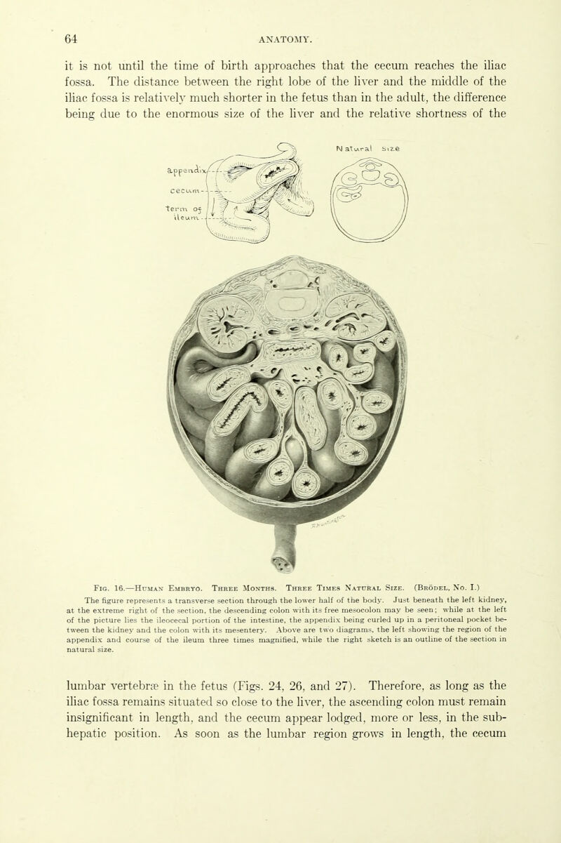 it is not until the time of birth approaches that the cecum reaches the ihac fossa. The distance between the right lobe of the liver and the middle of the iliac fossa is relatively much shorter in the fetus than in the adult, the difference being due to the enormous size of the liver and the relative shortness of the Fig. 16.—Human Embryo. Three Months. Three Ti.mes Natcr.^l Size. (Brodel, No. I.) The figure represents a transverse section through the lower half of the body. Just beneath the left kidney, at the extreme right of the section, the descending colon with its free mesocolon may be seen; while at the left of the picture lies the ileocecal portion of the intestine, the appendi-x being curled up in a peritoneal pocket be- tween the kidney and the colon with its mesentery. Above are two diagrams, the left showing the region of the appendix and course of the ileum three times magnified, while the right sketch is an outline of the .section in natural size. lumbar vertebrre in the fetus fFigs. 24, 26, and 27). Therefore, as long as the iliac fossa remains situated so close to the liver, the ascending colon must remain insignificant in length, and the cecum appear lodged, more or less, in the sub- hepatic position. As soon as the lumbar region grows in length, the cecum