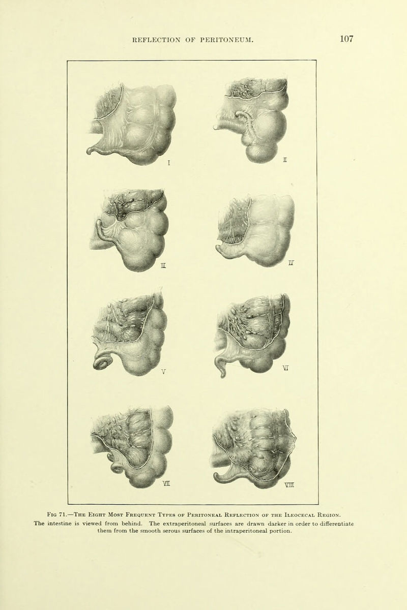 Fig 71.—The Eight Most Frequent Types of Peritoneal Reflection of the Ileocecal Region. The intestine is viewed from behind. The extraperitoneal surfaces are drawn darker in order to differentiate them from the smooth serous surfaces of the intraperitoneal portion.